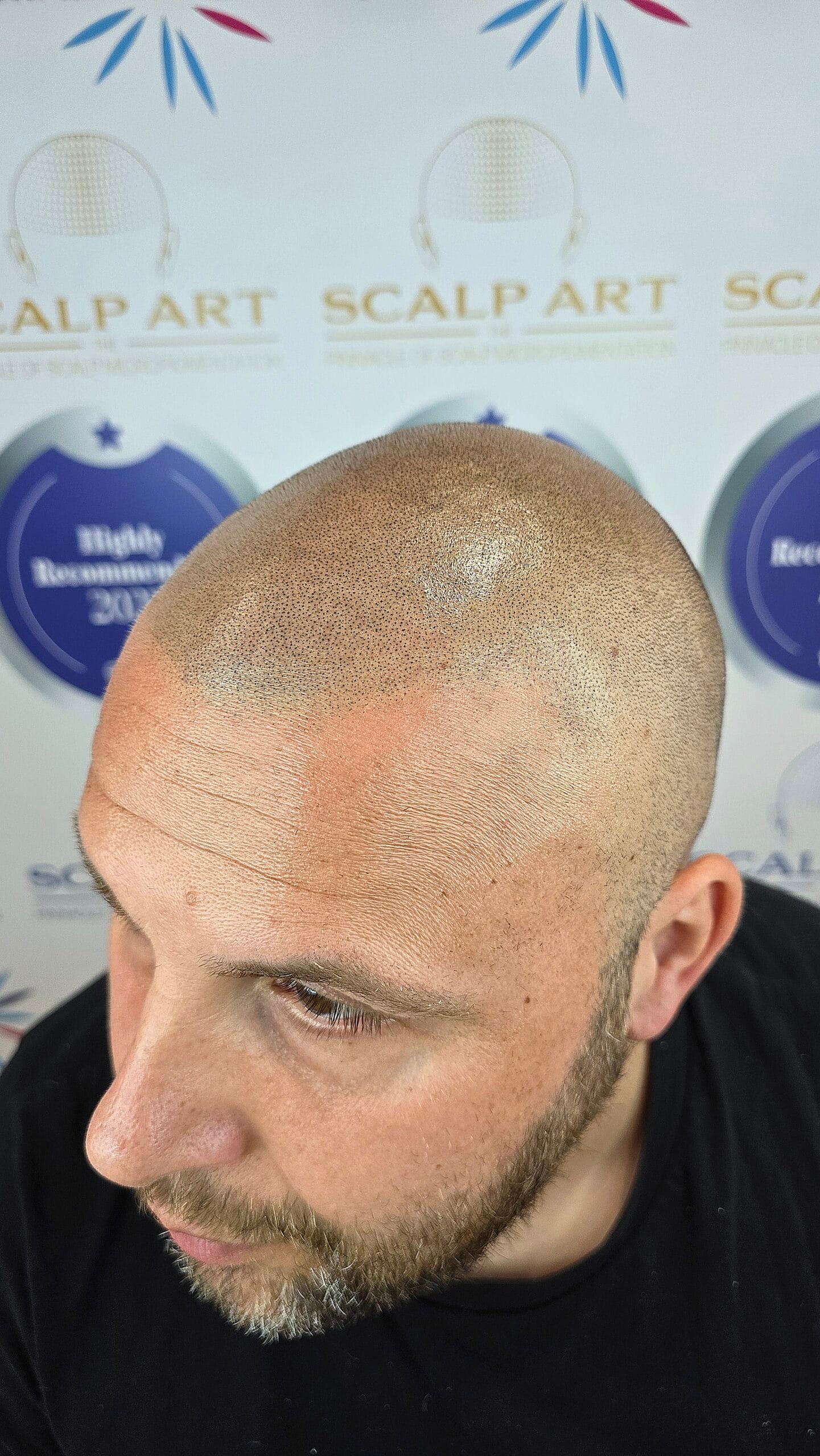 Scalp Micropigmentation (SMP) — treatment results — at Scalp Art Clinic — Chelmsford