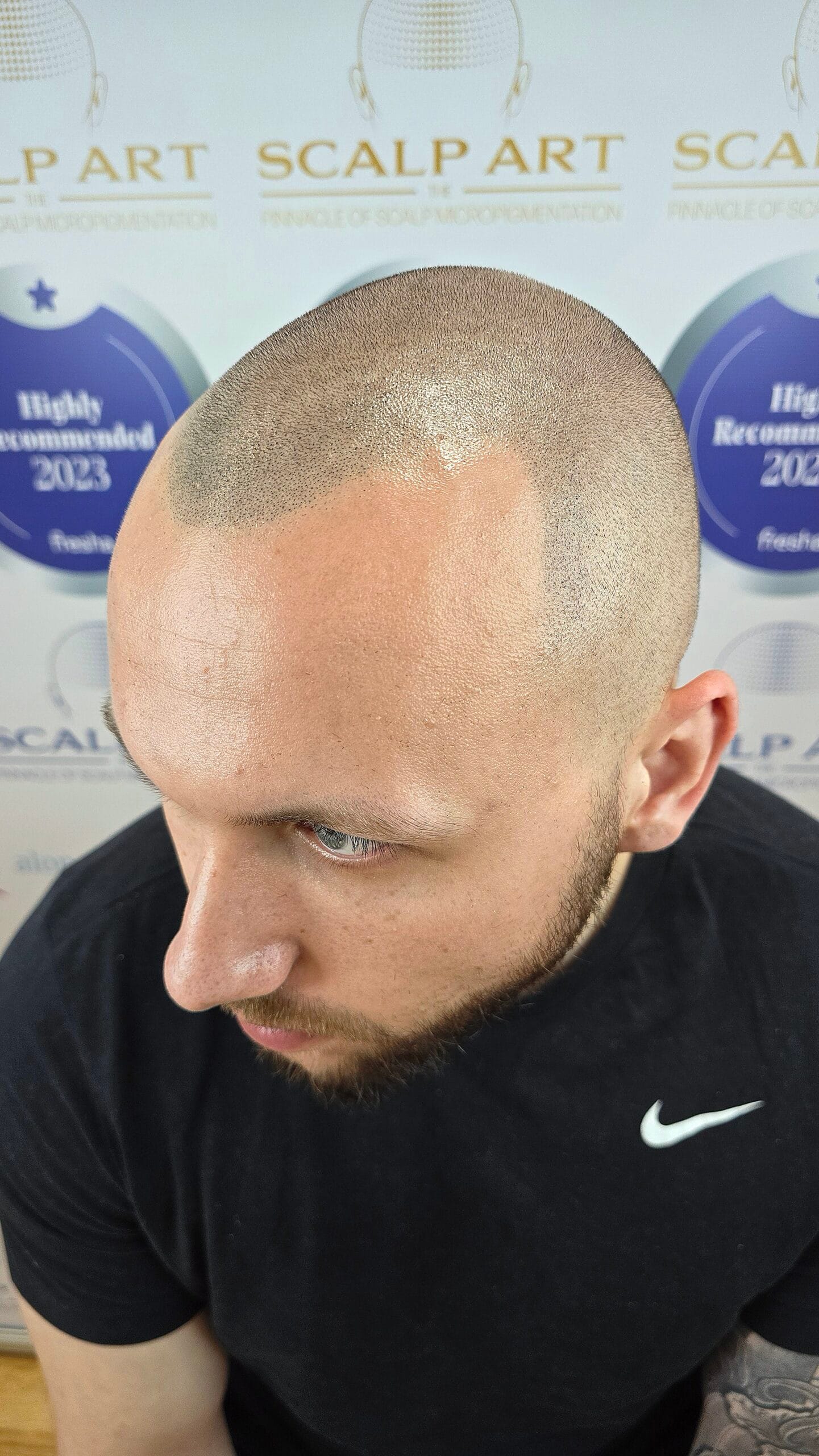 Scalp Micropigmentation (SMP) — treatment results — at Scalp Art Clinic — Chelmsford