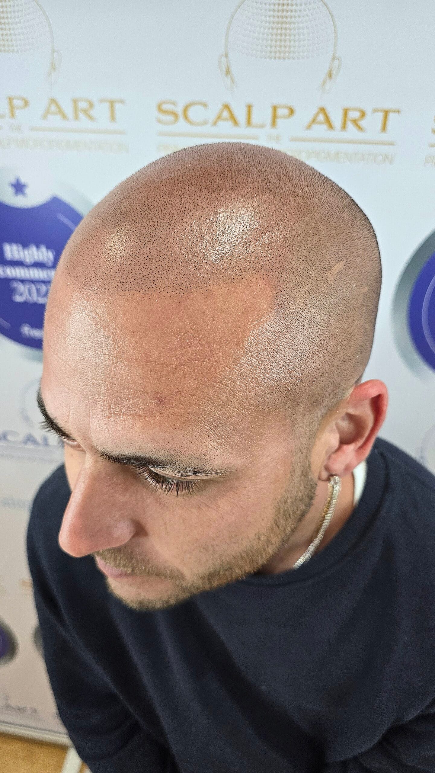 Scalp Micropigmentation (SMP) — treatment results — at Scalp Art Clinic — Chelmsford