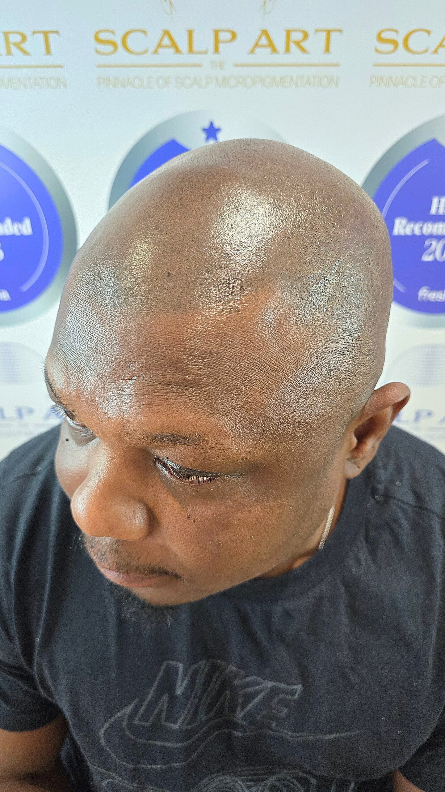 Scalp Micropigmentation (SMP) — treatment results — at Scalp Art Clinic — Chelmsford
