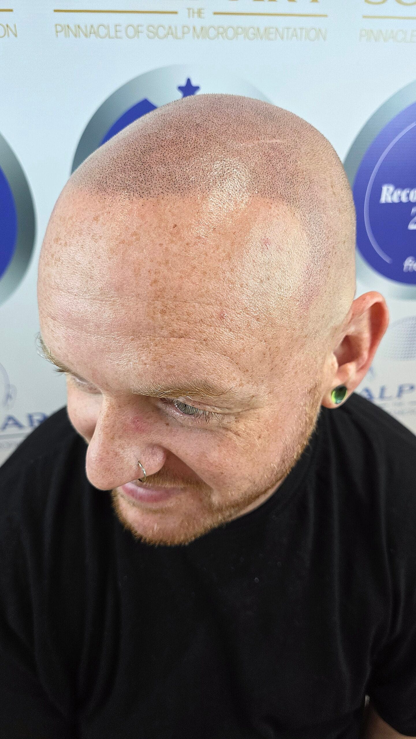 Scalp Micropigmentation (SMP) — treatment results — at Scalp Art Clinic — Chelmsford