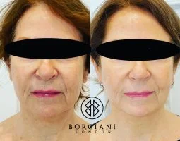 Treatment by Borciani London