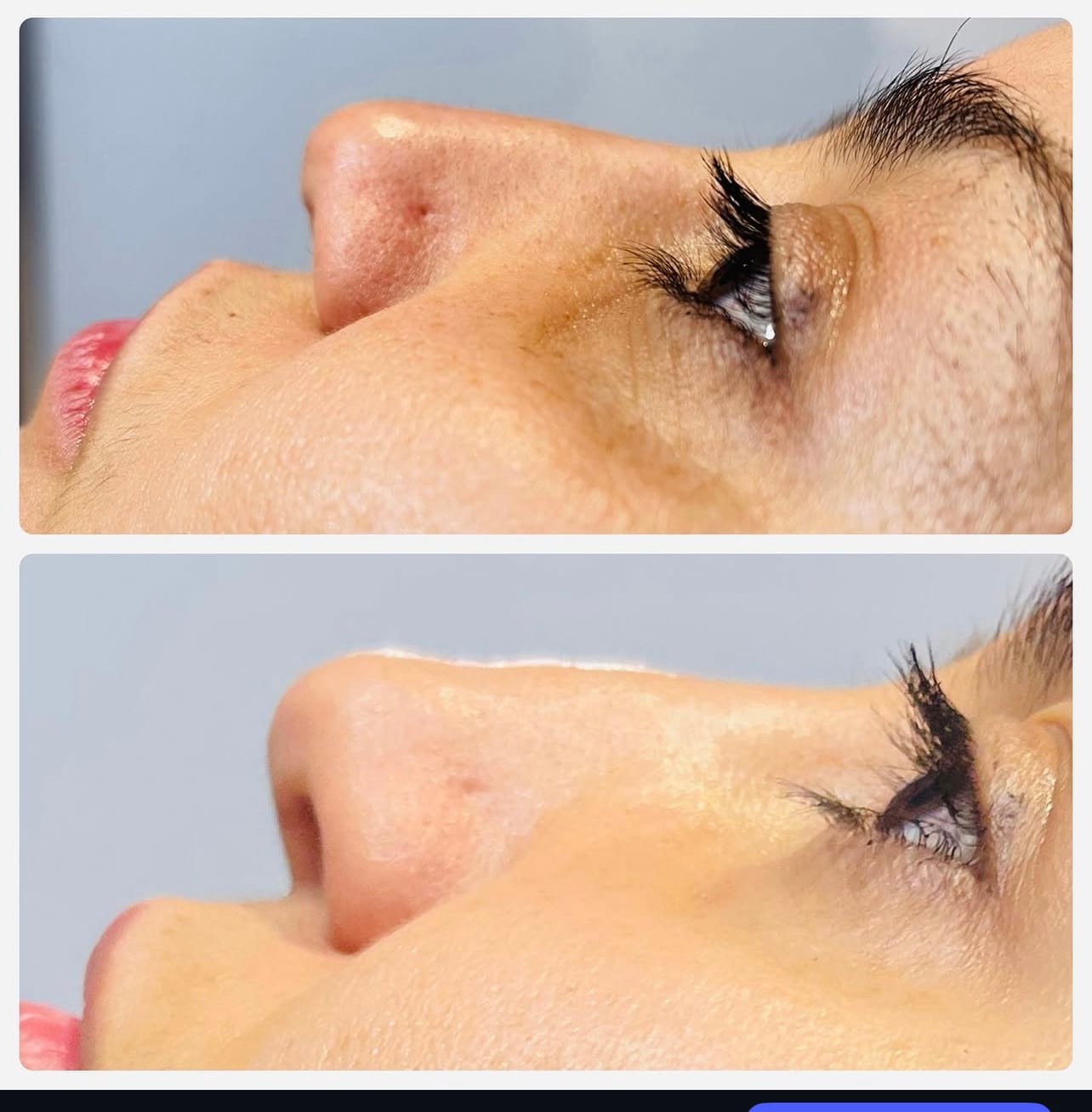 Nose Reshaping (Non-Surgical Rhinoplasty)