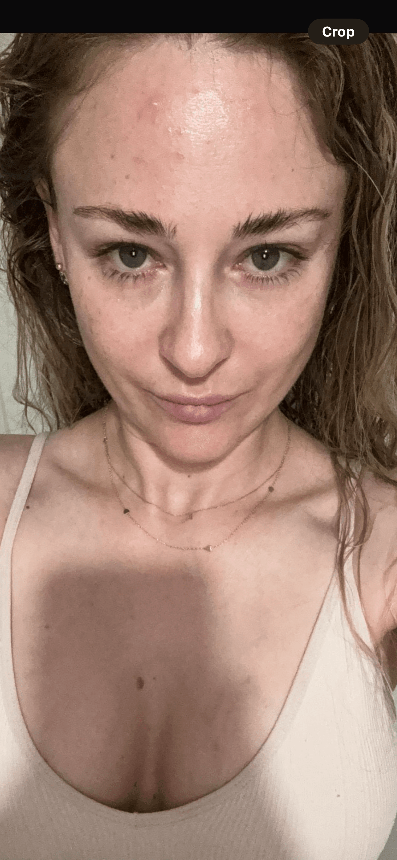Tear Trough Injections — treatment results — at Promise Aesthetics — Twickenham