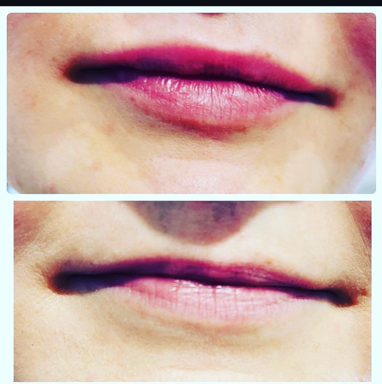 Lip Filler (Augmentation) — before and after results — at Promise Aesthetics — Twickenham
