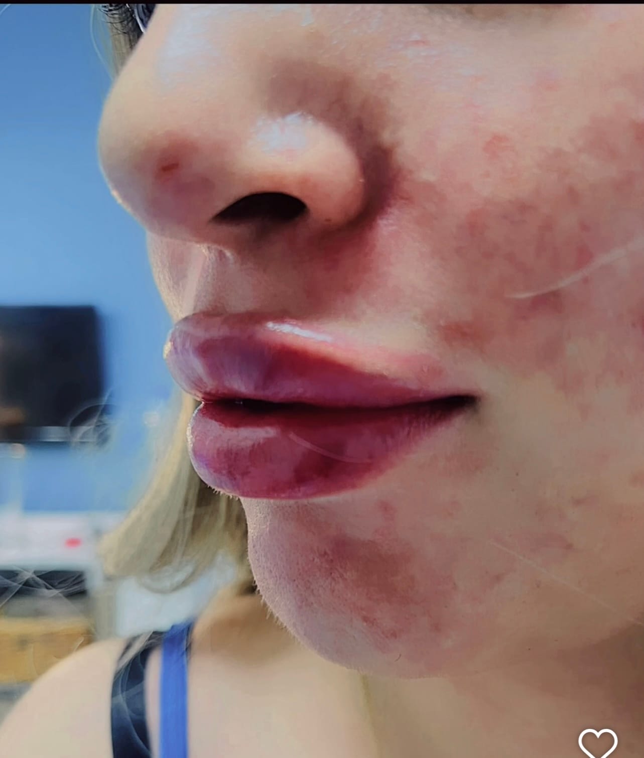 Lip Filler (Augmentation) — before and after results — at Promise Aesthetics — Twickenham