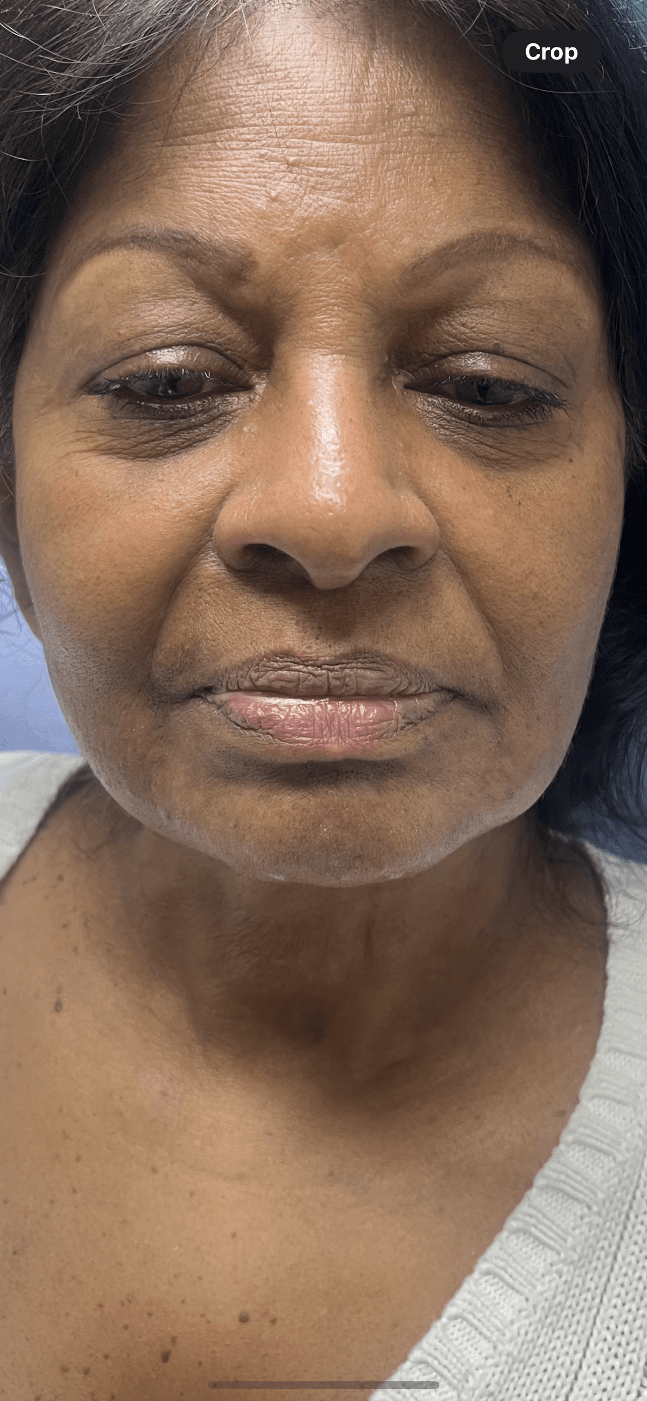 Marionette Lines (Injectables) — treatment results — at Promise Aesthetics — Twickenham