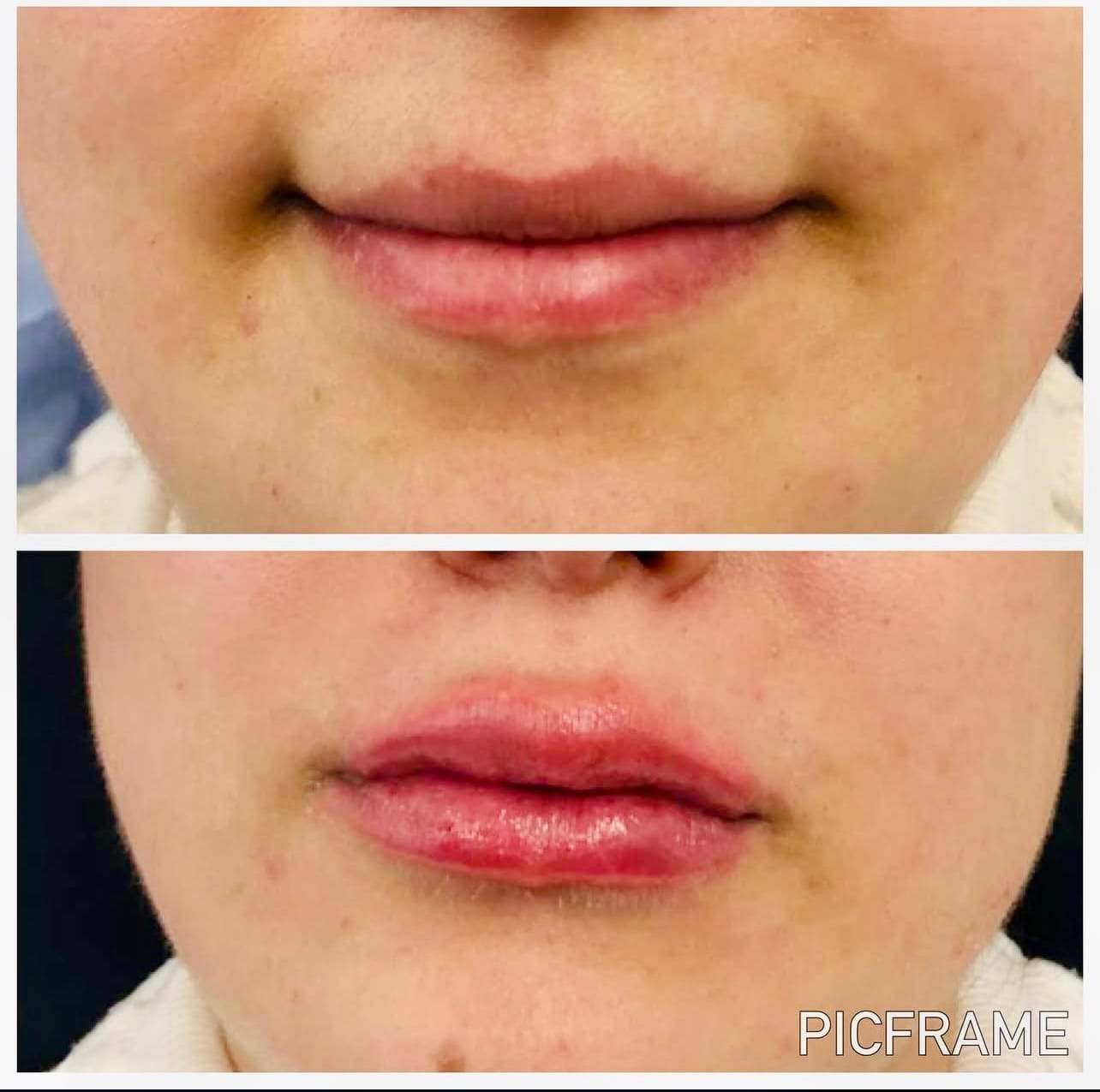 Lip Filler (Augmentation) — before and after results — at Promise Aesthetics — Twickenham