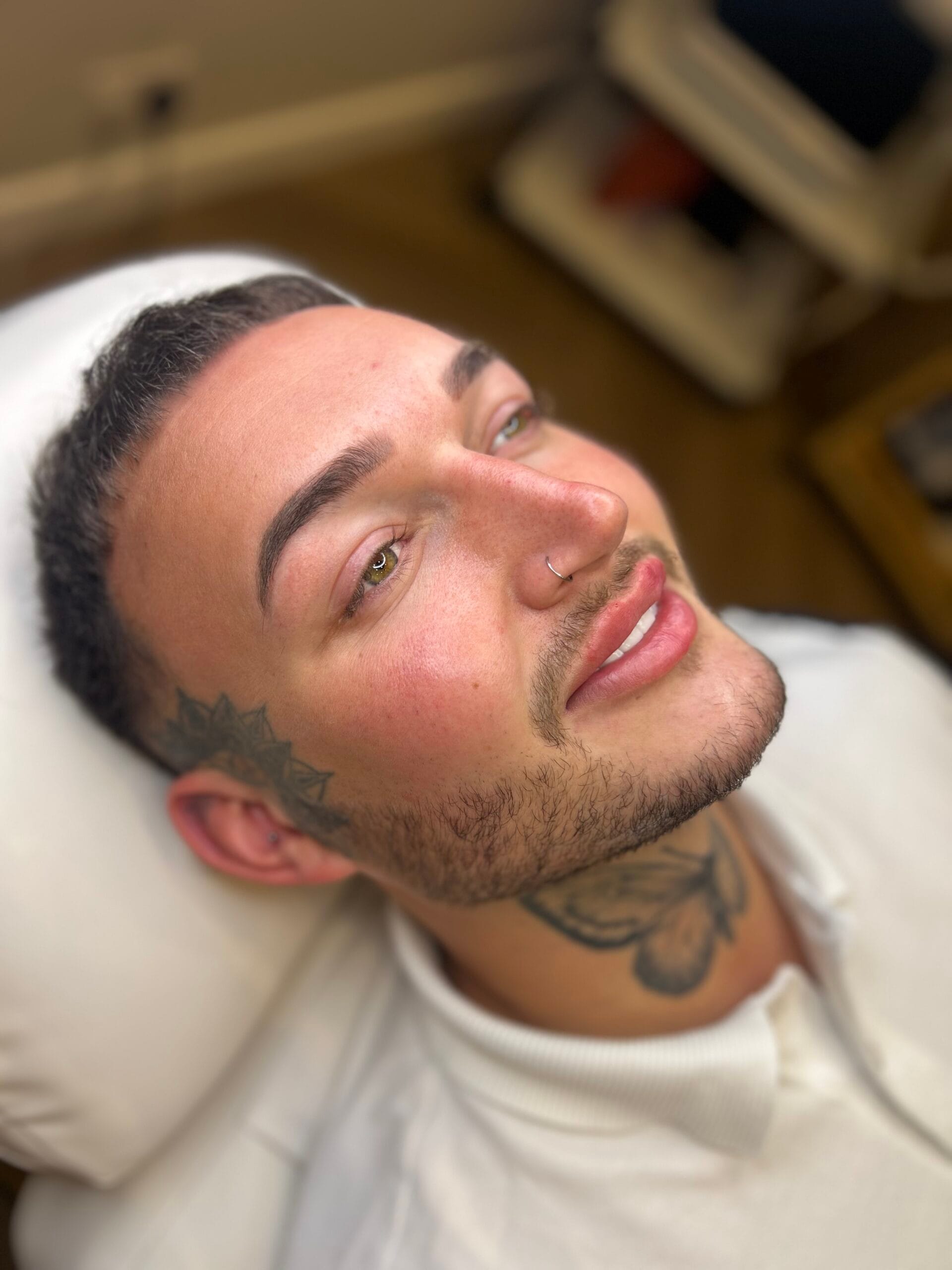Jaw Filler — before and after results — at Enhance Taunton — Taunton