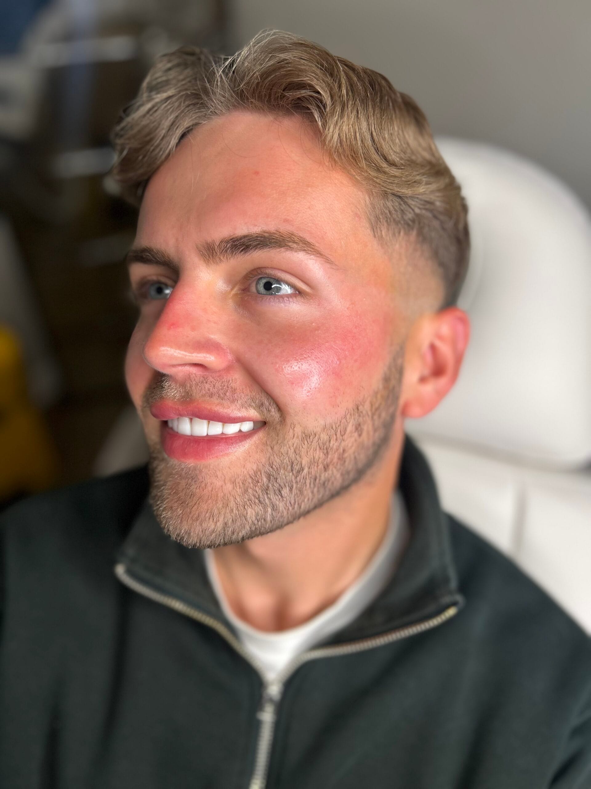 Cheek Fillers — treatment results — at Enhance Taunton — Taunton