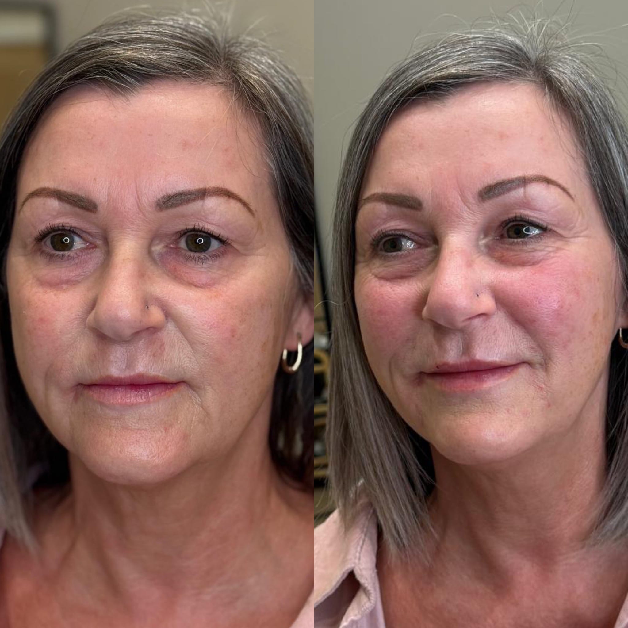 Dermal Filler Injections — before and after results — at Enhance Taunton — Taunton