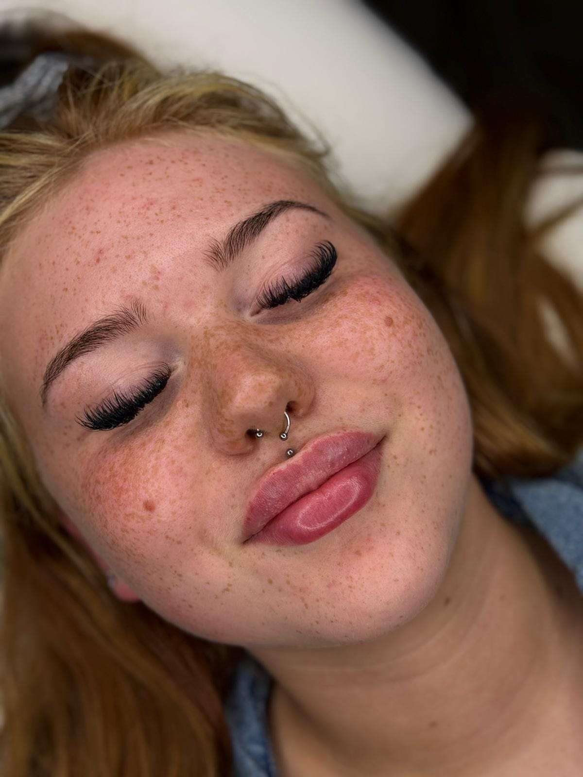 Lip Filler (Augmentation) — treatment results — at Enhance Taunton — Taunton