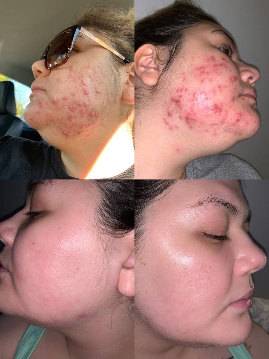Acne Treatment — treatment results — at Enhance Taunton — Taunton