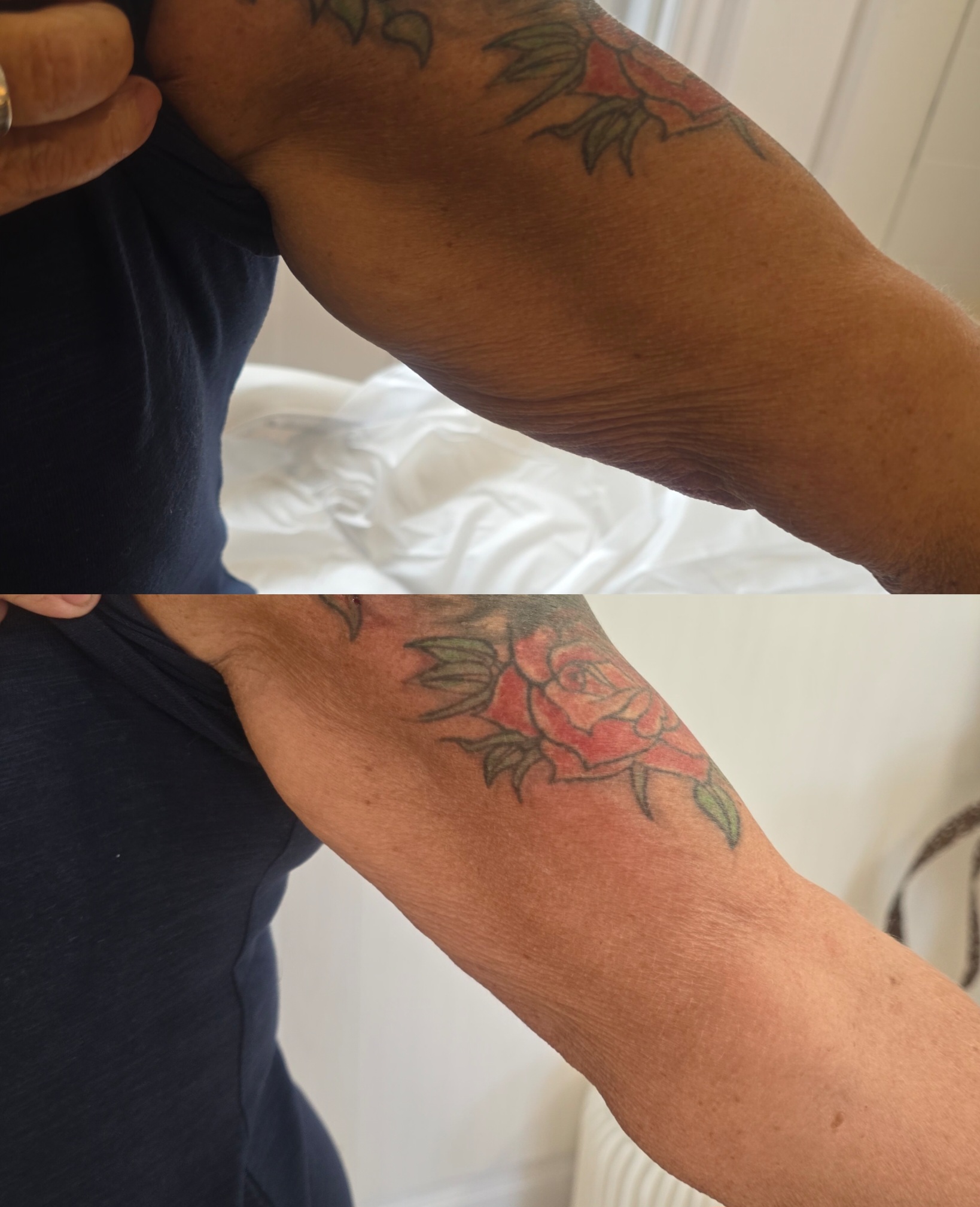 Intense Pulsed Light (IPL)