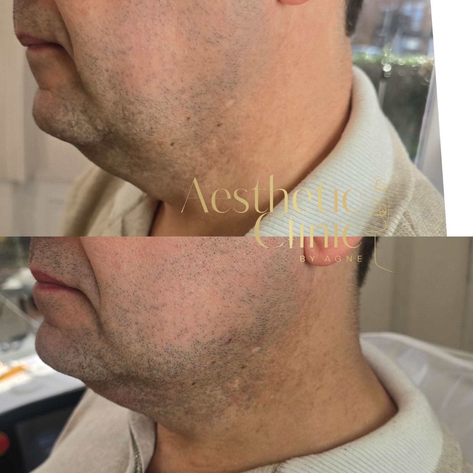 Intense Pulsed Light (IPL)