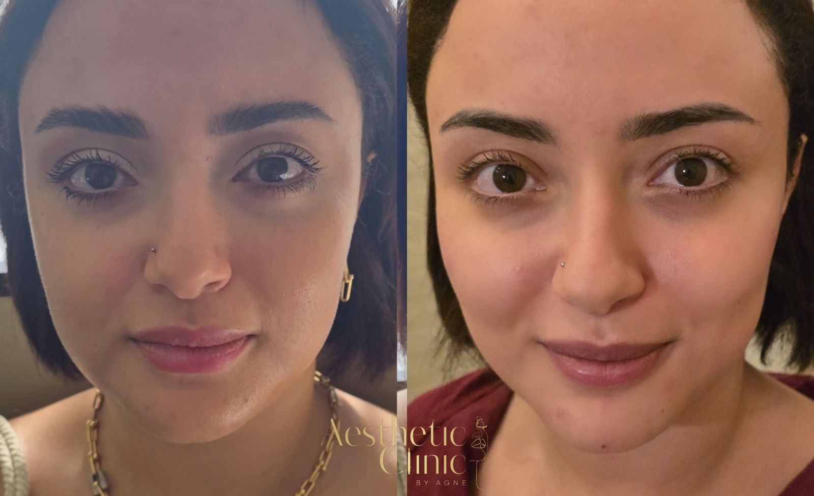 Face Lift (Injectables)