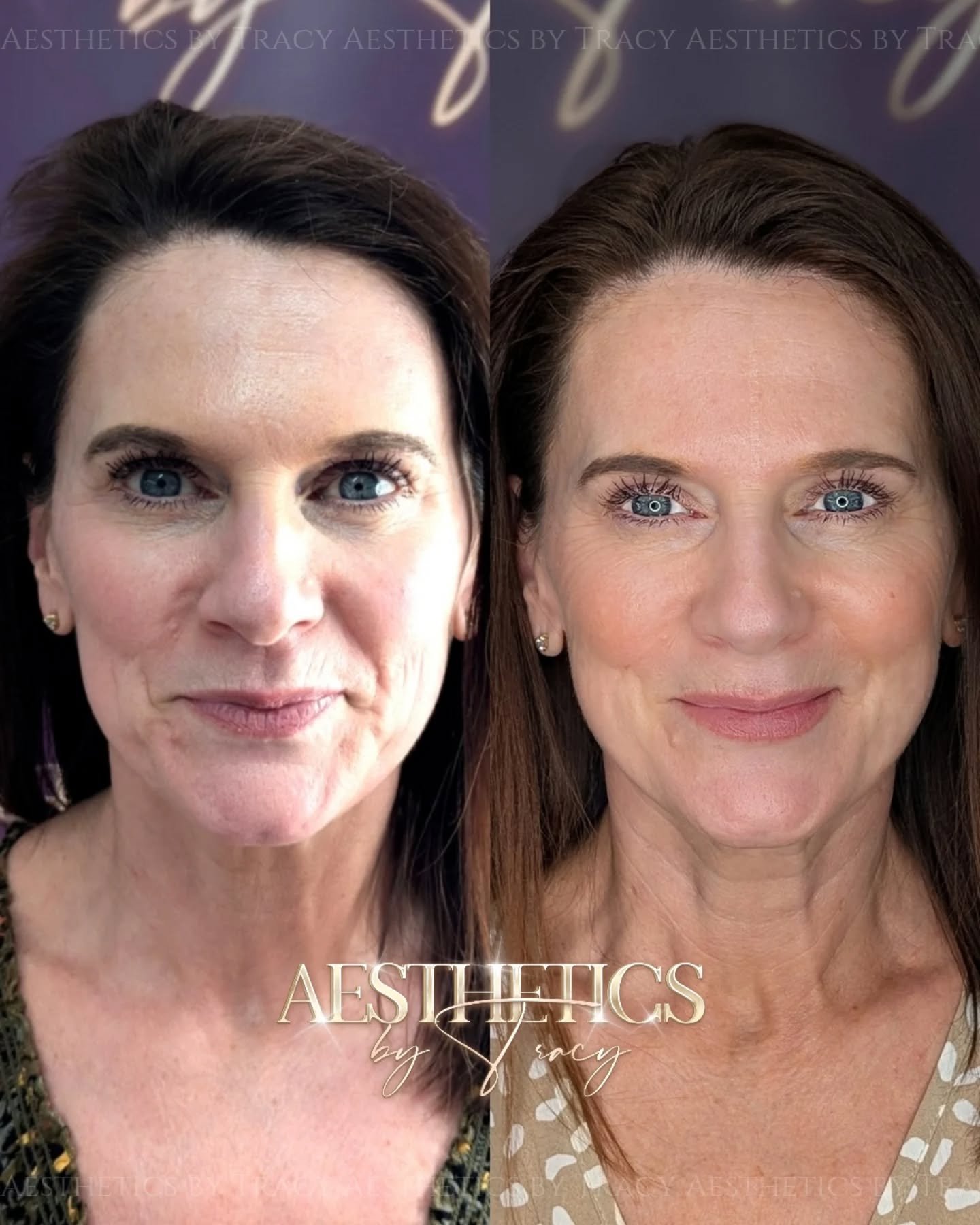 Biorevitalization — before and after results — at Aesthetics by Tracy — Towcester