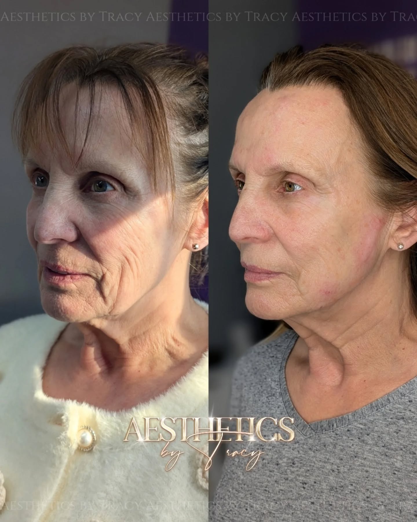 Biorevitalization — before and after results — at Aesthetics by Tracy — Towcester