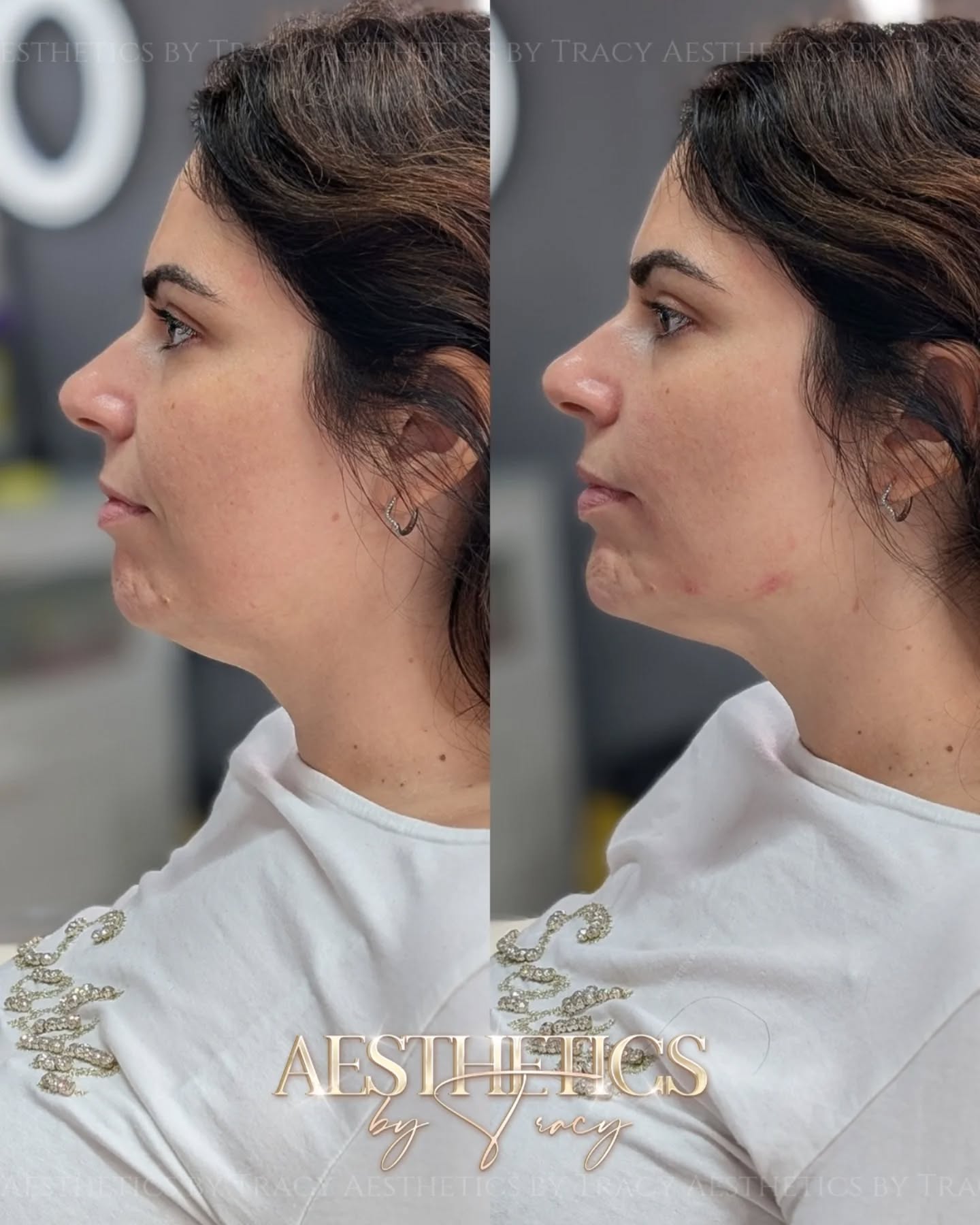 Chin Filler — before and after results — at Aesthetics by Tracy — Towcester