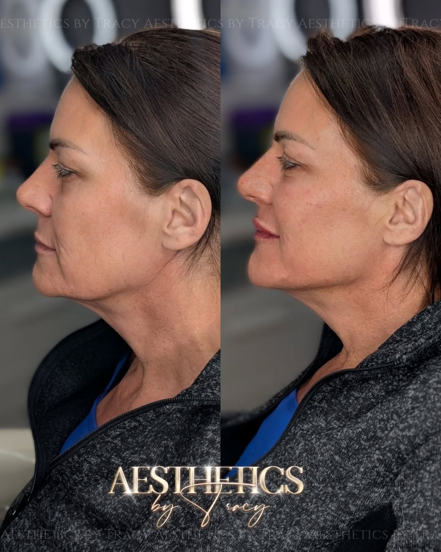 Face Lift (Injectables) — before and after results — at Aesthetics by Tracy — Towcester