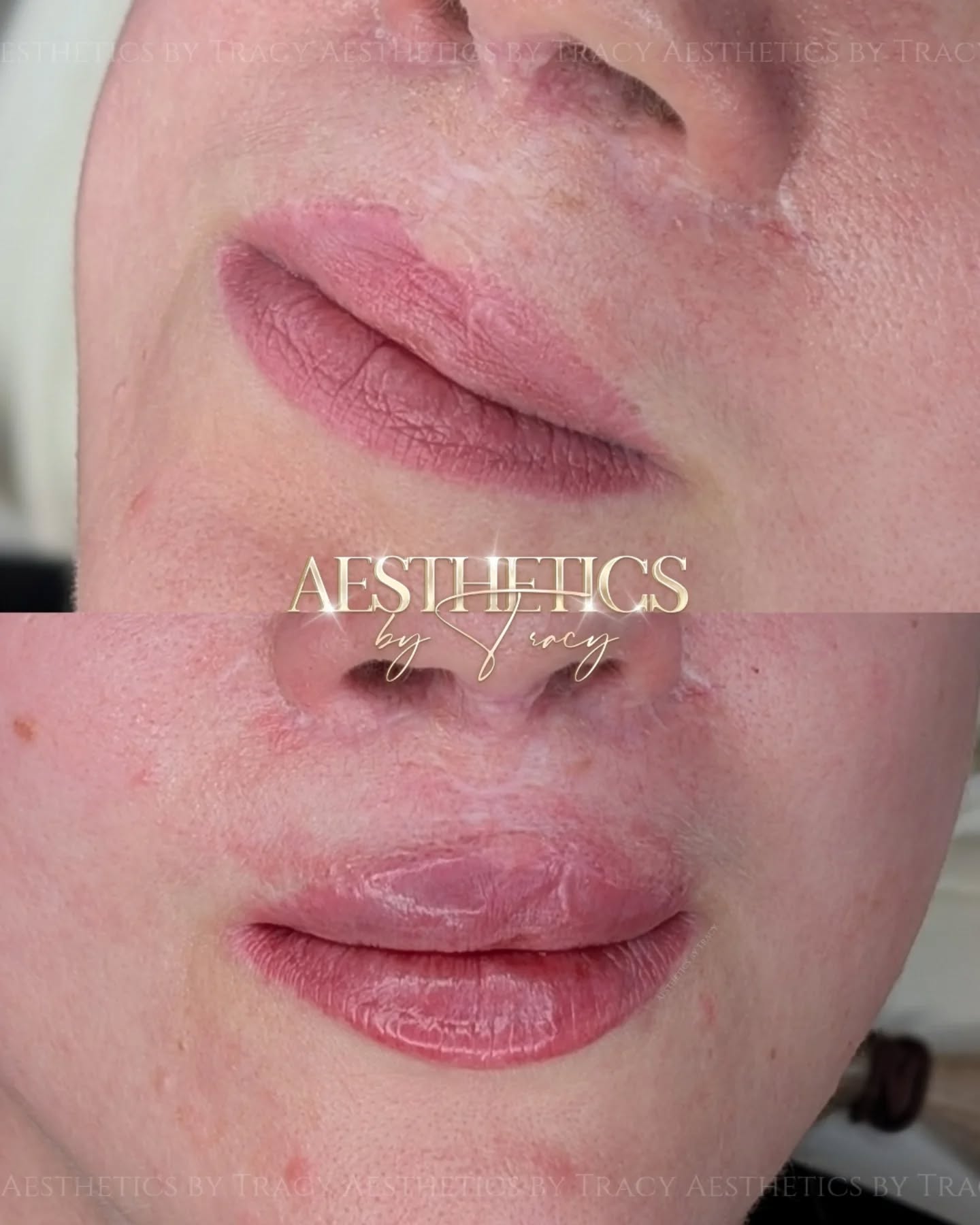 Lip Filler (Augmentation) — before and after results — at Aesthetics by Tracy — Towcester