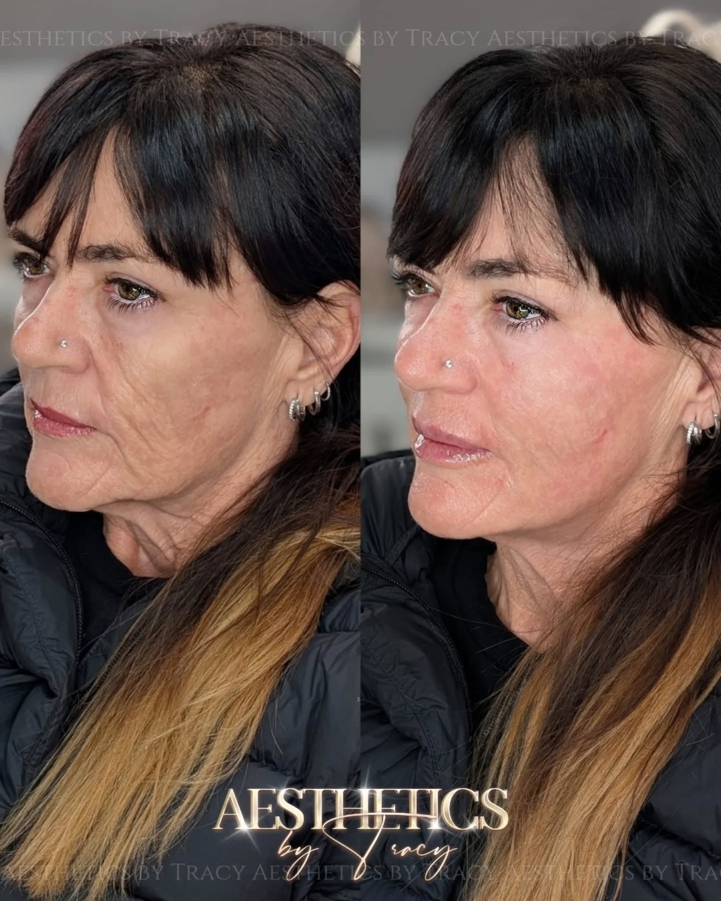 Face Lift (Injectables) — before and after results — at Aesthetics by Tracy — Towcester