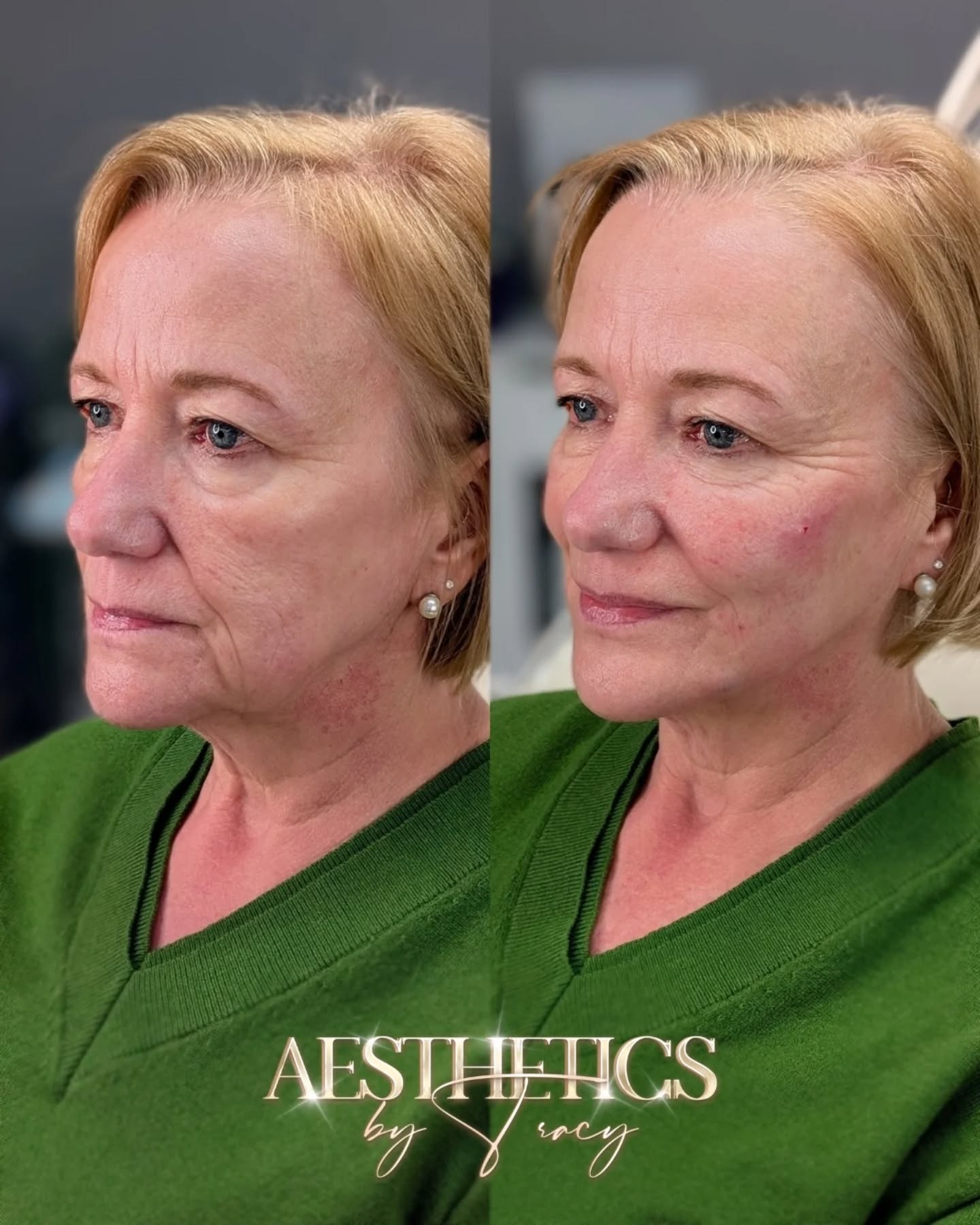 Face Lift (Injectables) — before and after results — at Aesthetics by Tracy — Towcester