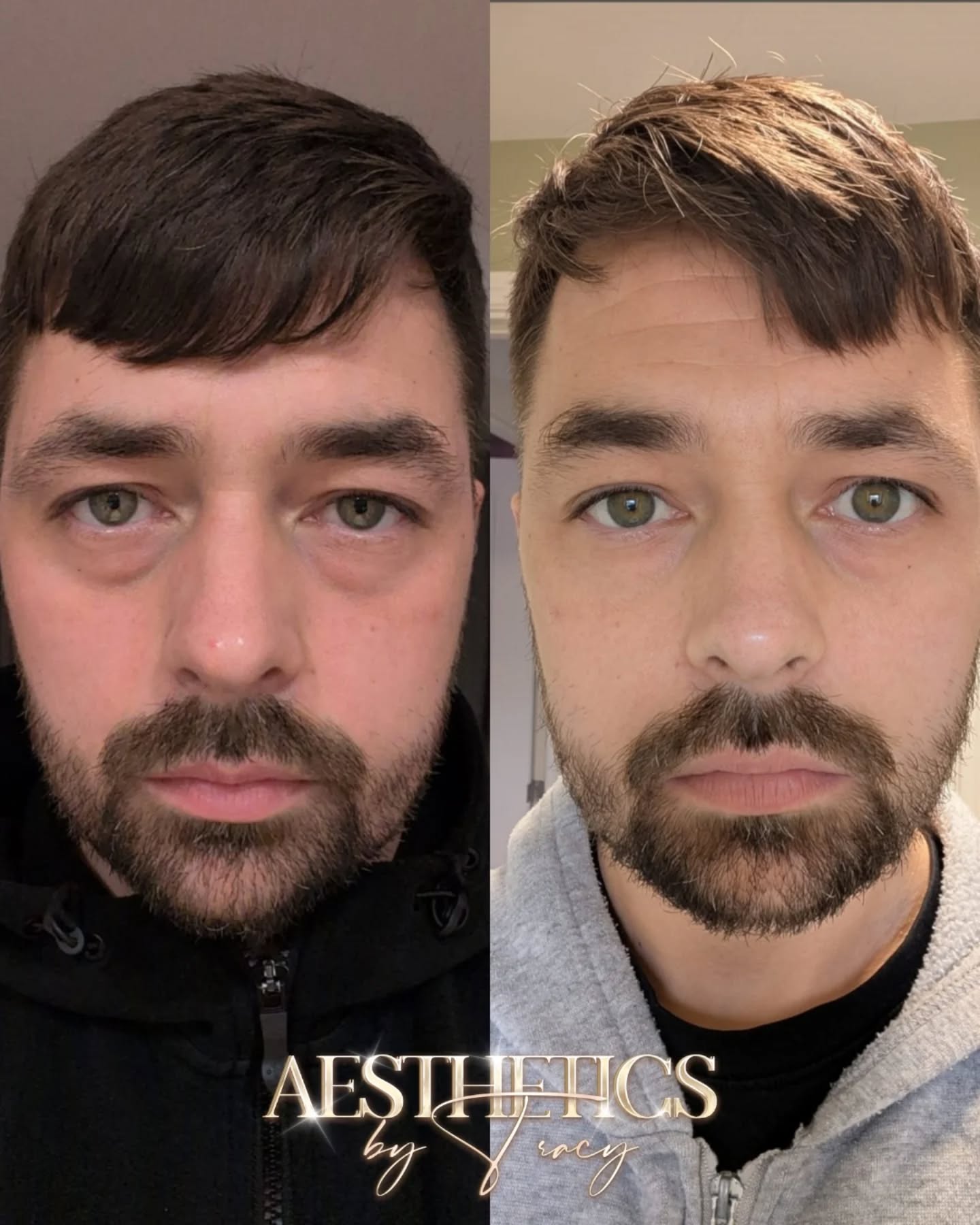 Eye Rejuvenation Injectables — before and after results — at Aesthetics by Tracy — Towcester