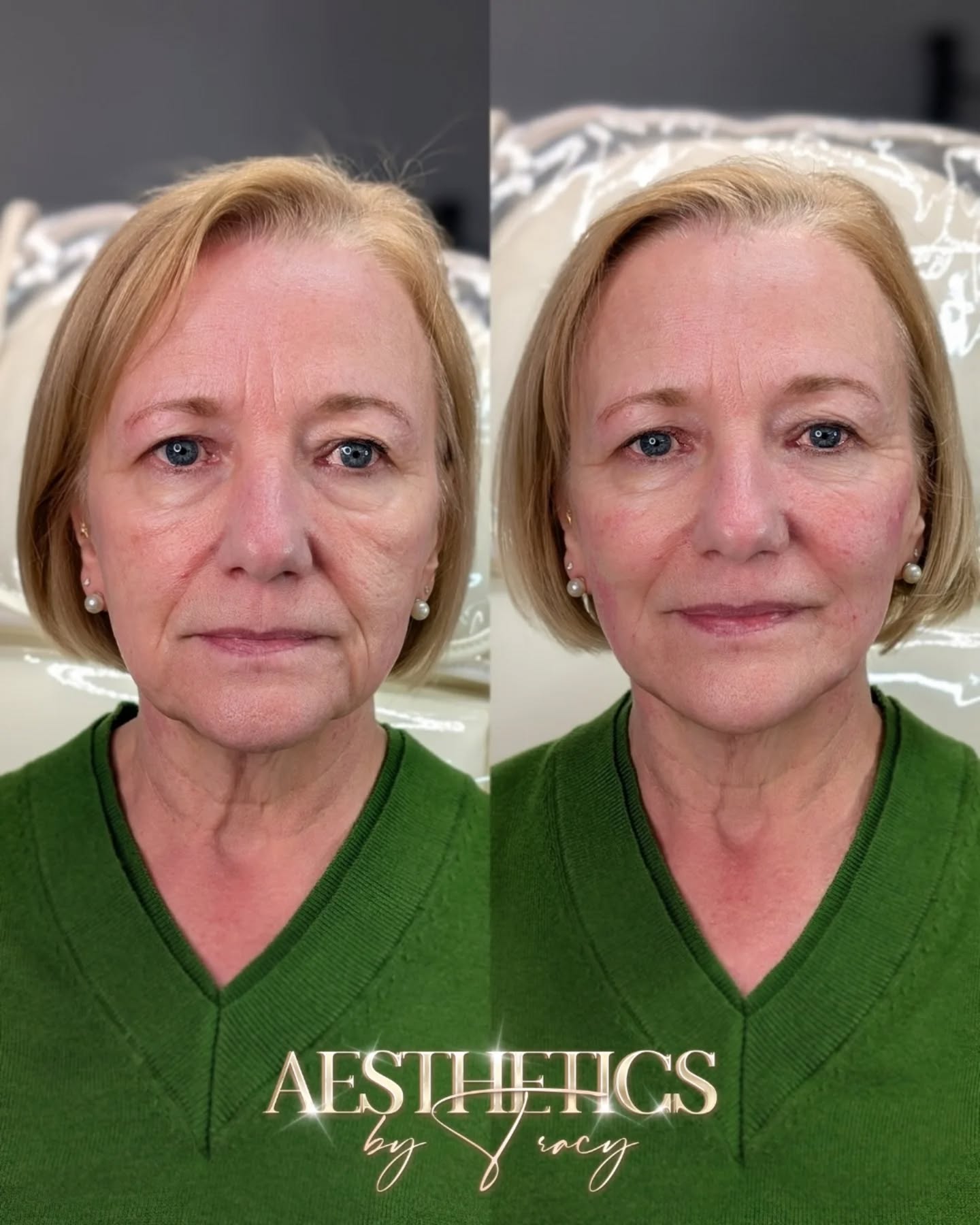 Face Lift (Injectables) — before and after results — at Aesthetics by Tracy — Towcester
