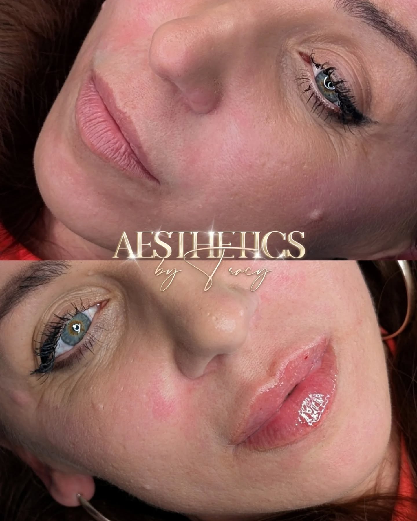Lip Filler (Augmentation) — before and after results — at Aesthetics by Tracy — Towcester