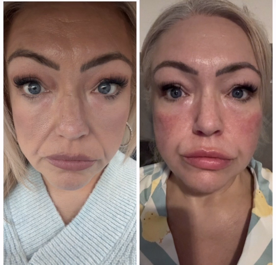 Cheek Fillers — before and after results — at Promise Aesthetics — Twickenham