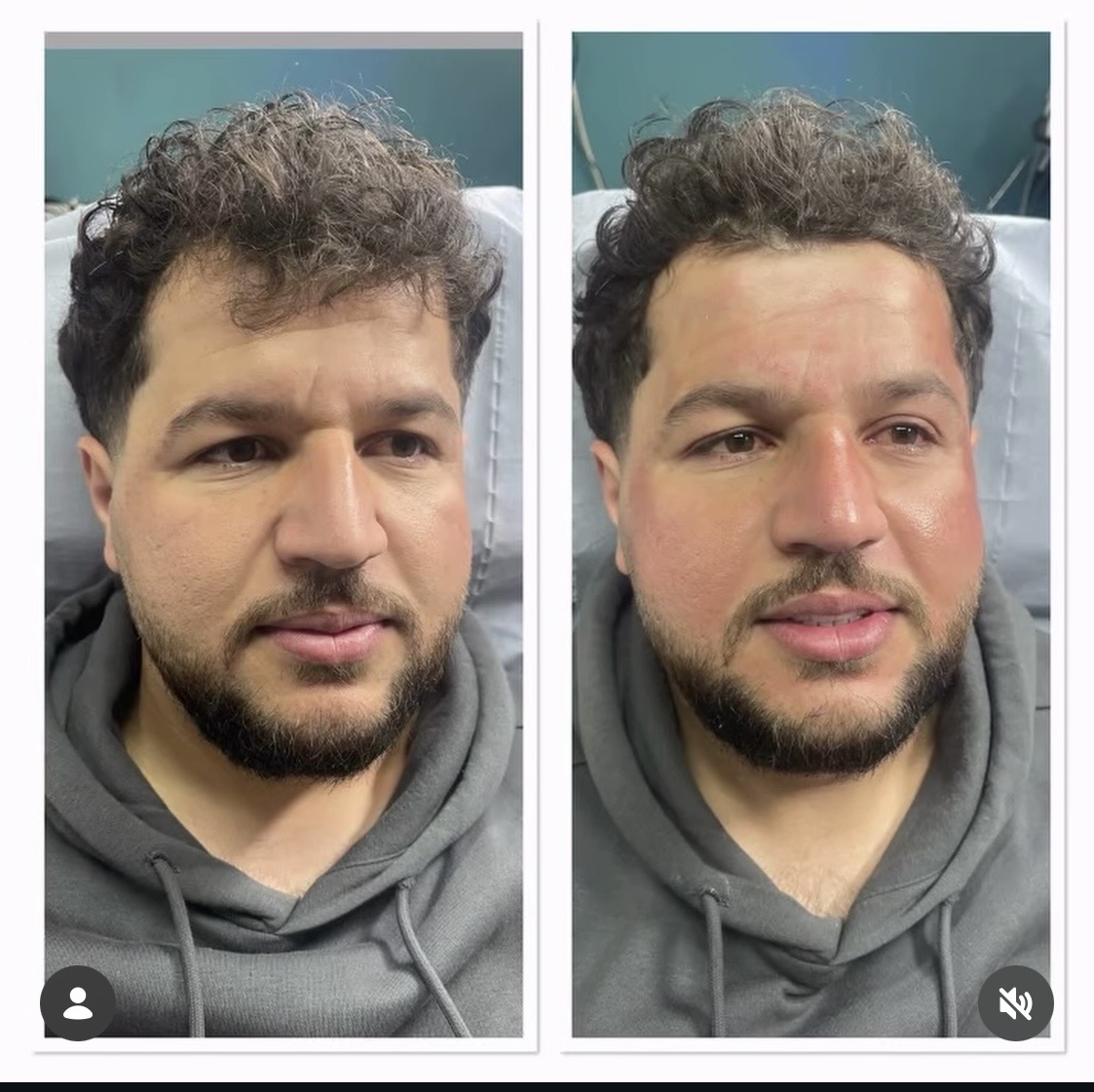 Microneedling — before and after results — at Promise Aesthetics — Twickenham