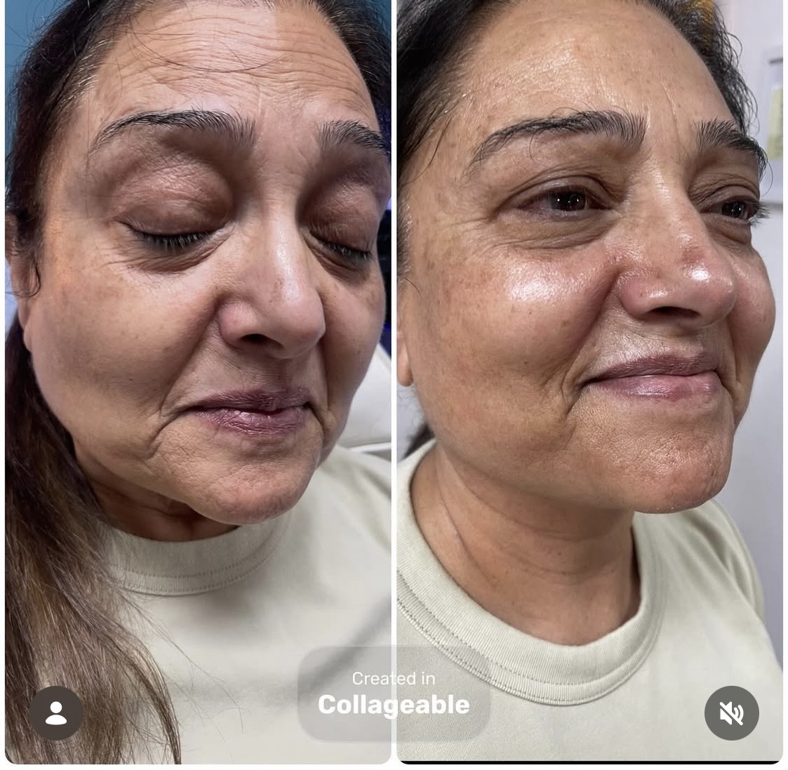 Hydrafacial — before and after results — at Promise Aesthetics — Twickenham