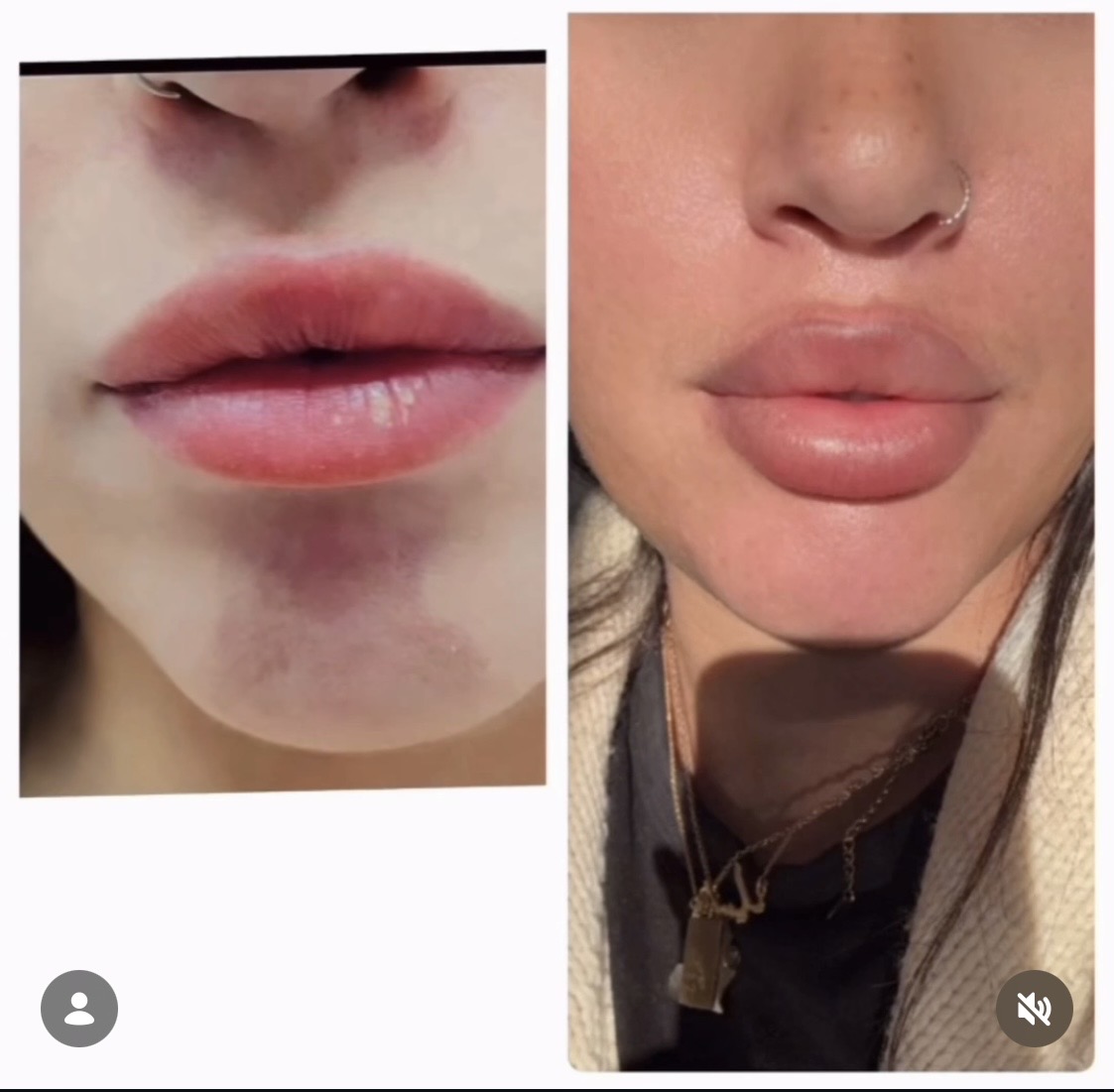 Lip Filler (Augmentation) — before and after results — at Promise Aesthetics — Twickenham