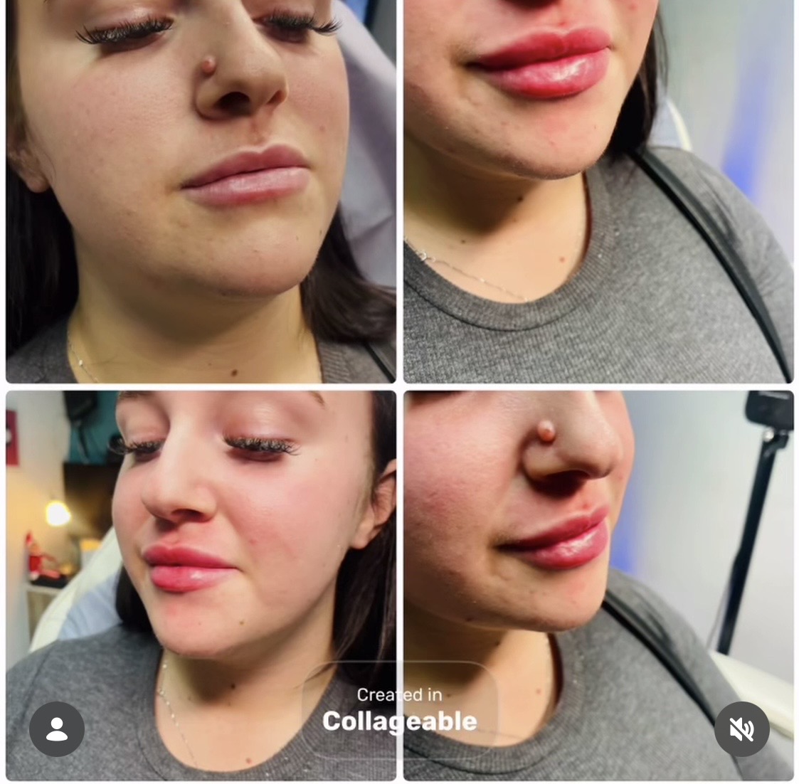 Lip Filler (Augmentation) — before and after results — at Promise Aesthetics — Twickenham