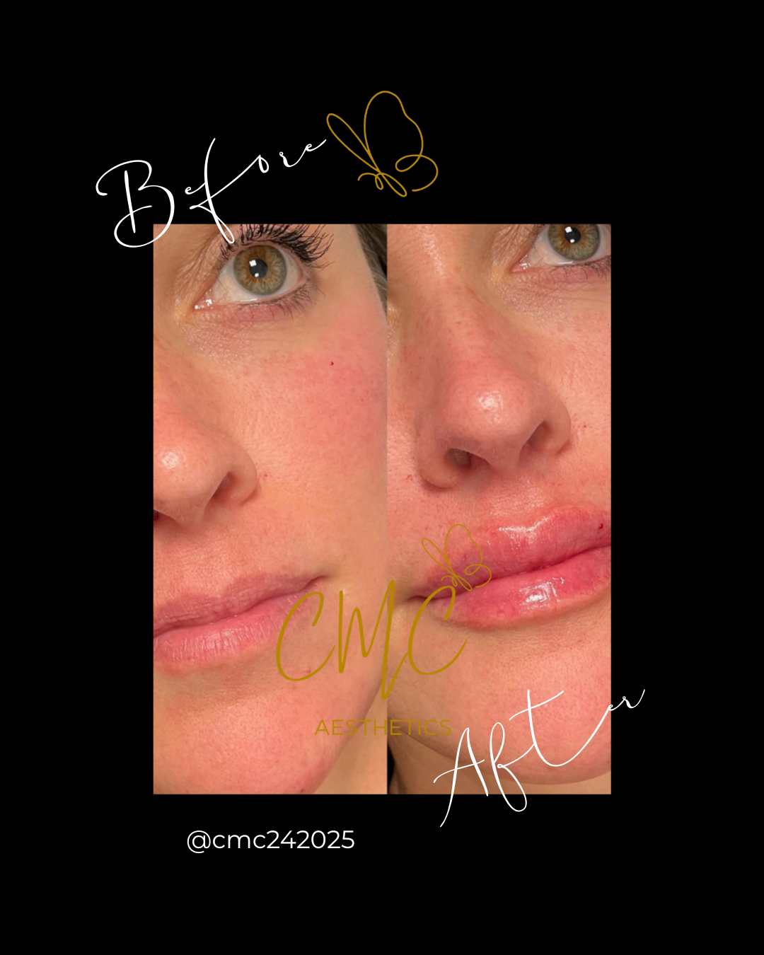 Lip Filler (Augmentation) — treatment results — at Tan Junkie — Aldershot