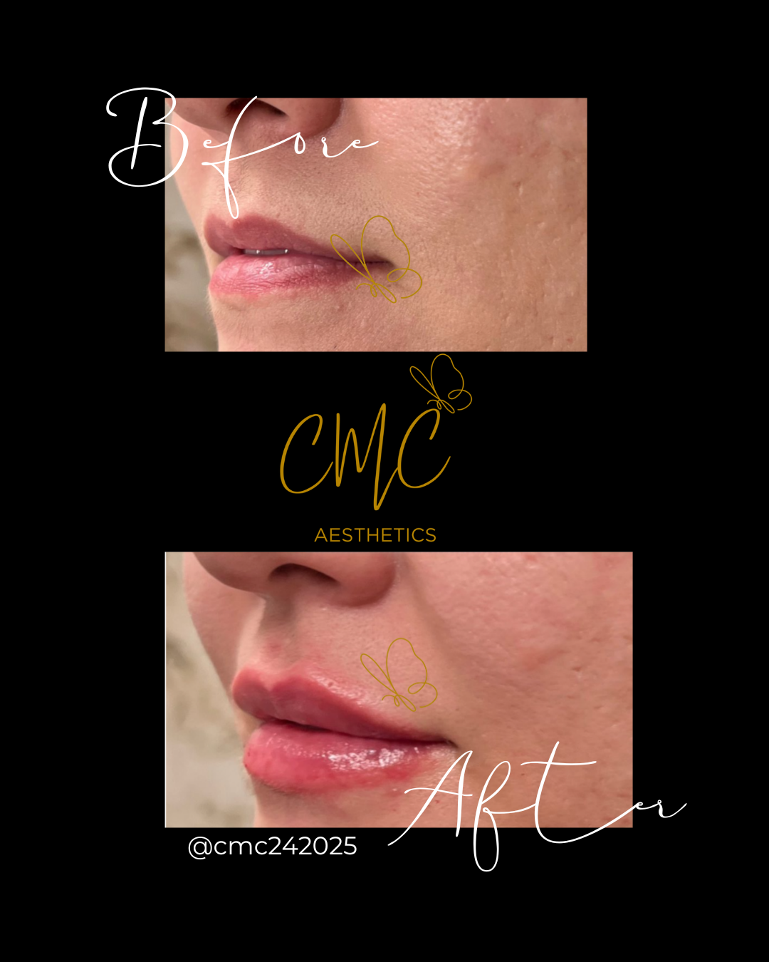 Lip Filler (Augmentation) — treatment results — at Tan Junkie — Aldershot