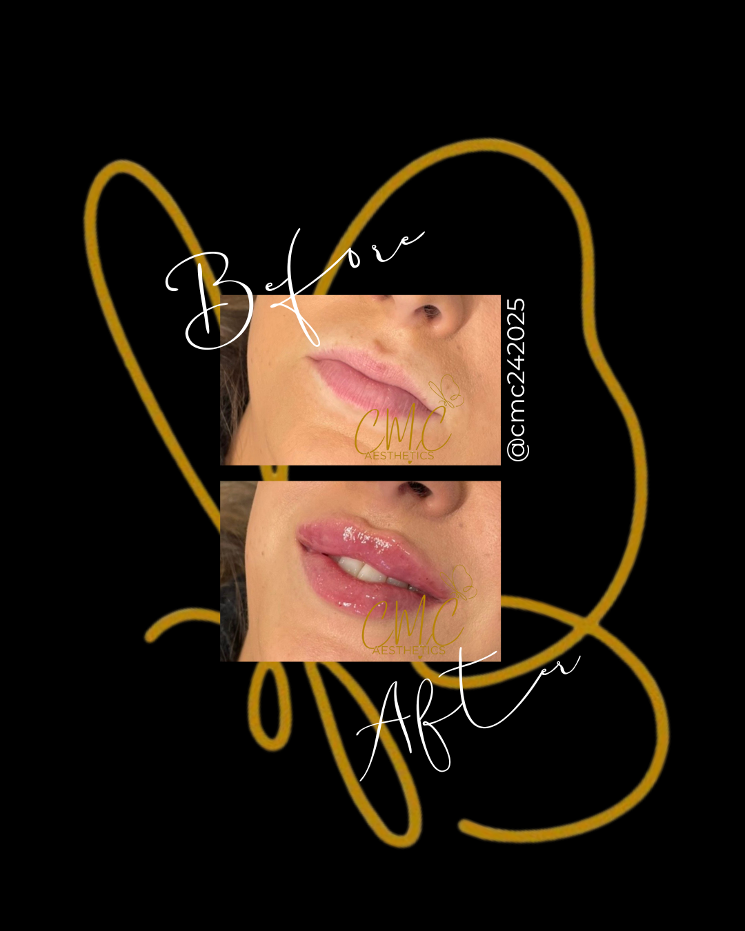 Lip Filler (Augmentation) — treatment results — at Tan Junkie — Aldershot
