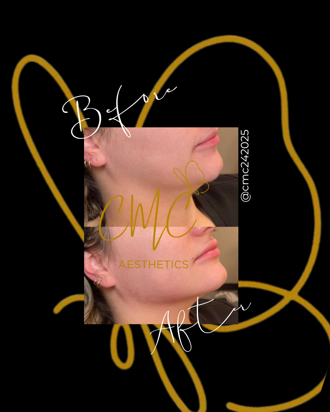 Jaw Filler — treatment results — at Tan Junkie — Aldershot