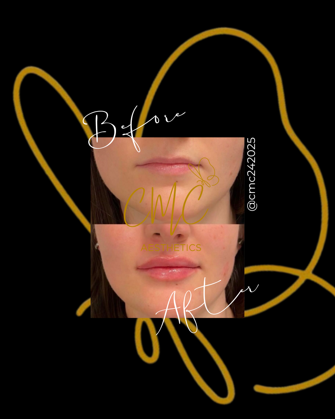 Lip Filler (Augmentation) — treatment results — at Tan Junkie — Aldershot