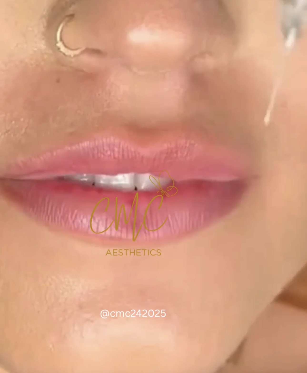 Lip Filler (Augmentation) — treatment results — at Tan Junkie — Aldershot