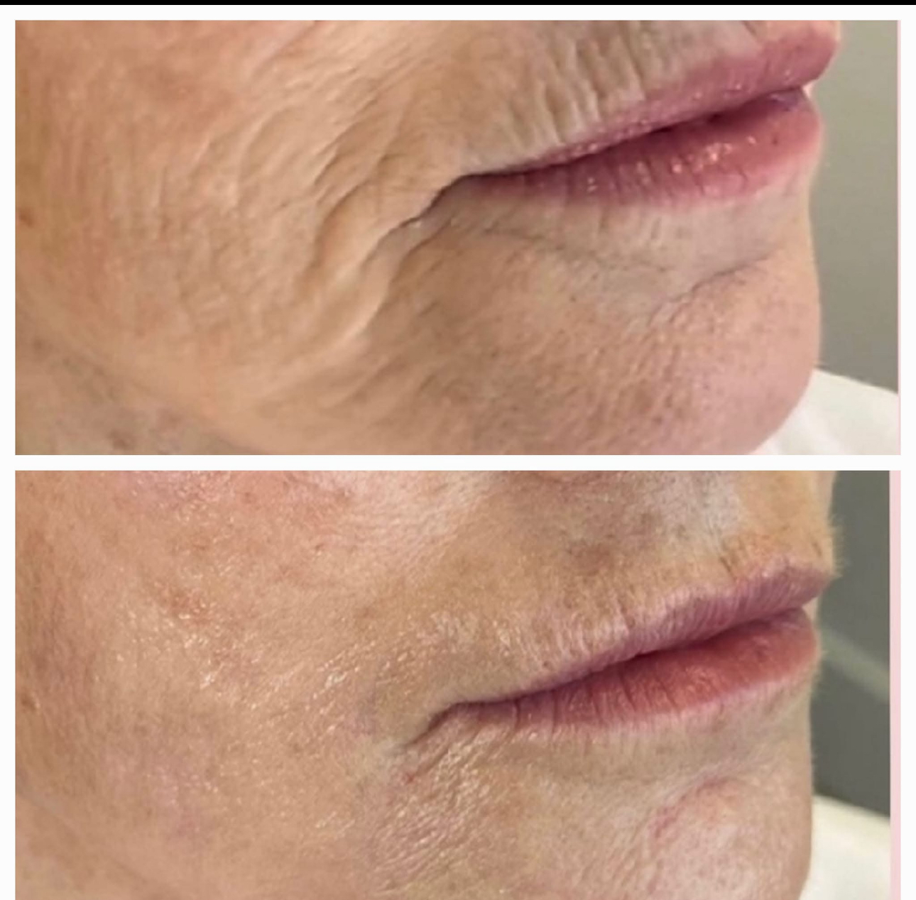 CO2 Laser Treatments