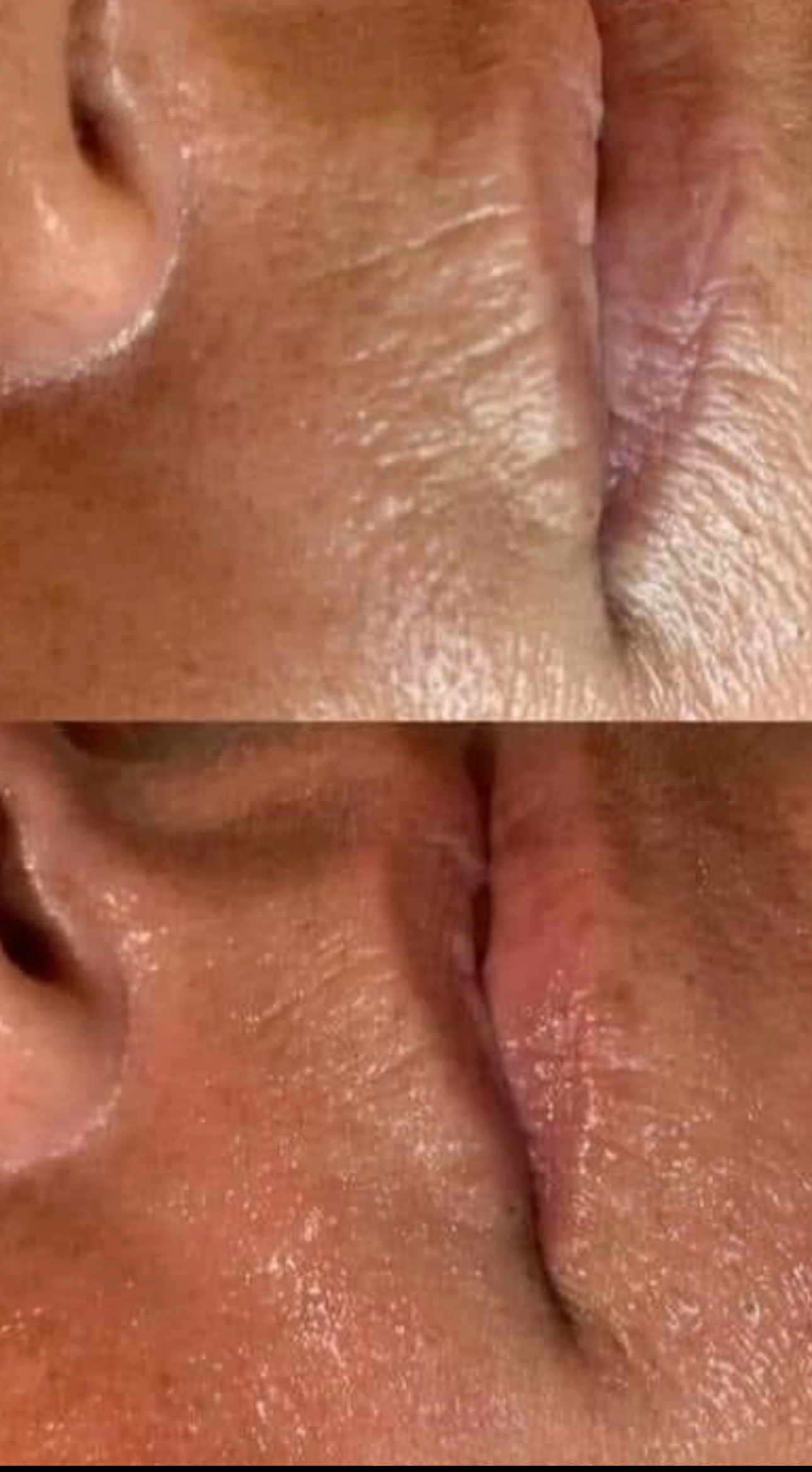 Dermal Filler Injections