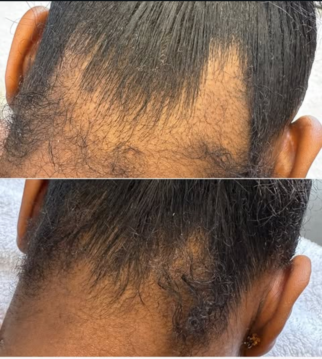 Microneedling — before and after results — at CurrentBody Skin: The Clinic — Alderley Edge