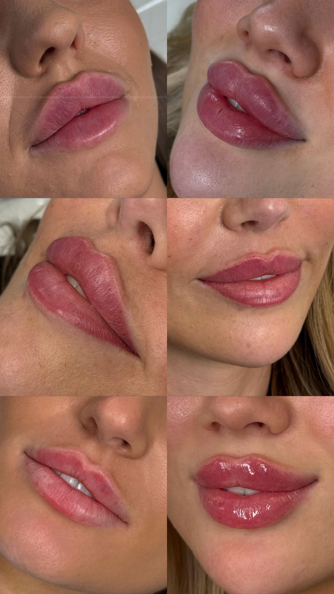 Lip Filler (Augmentation) — treatment results — at The Aesthetics Fix — Southampton