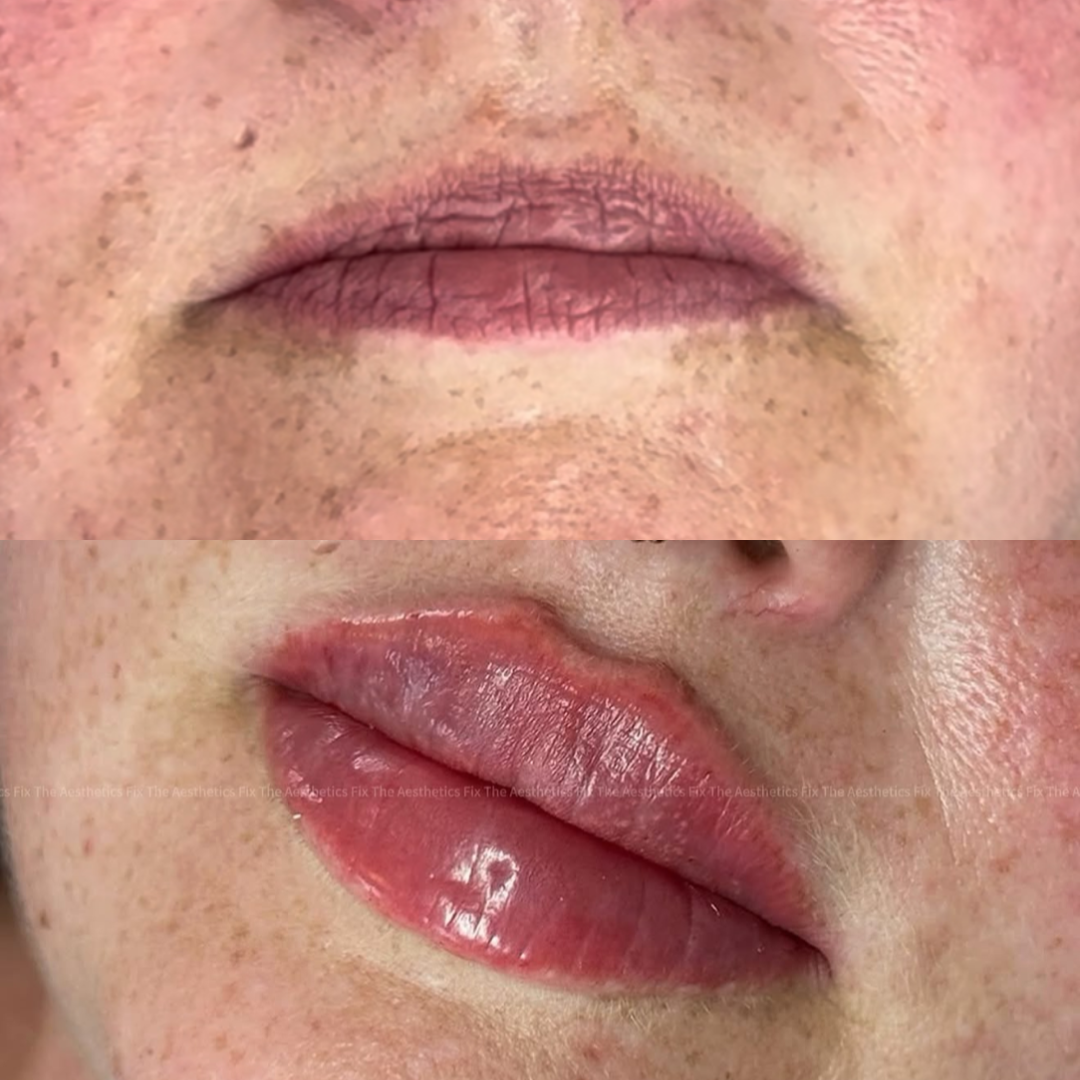 Lip Filler (Augmentation) — treatment results — at The Aesthetics Fix — Southampton