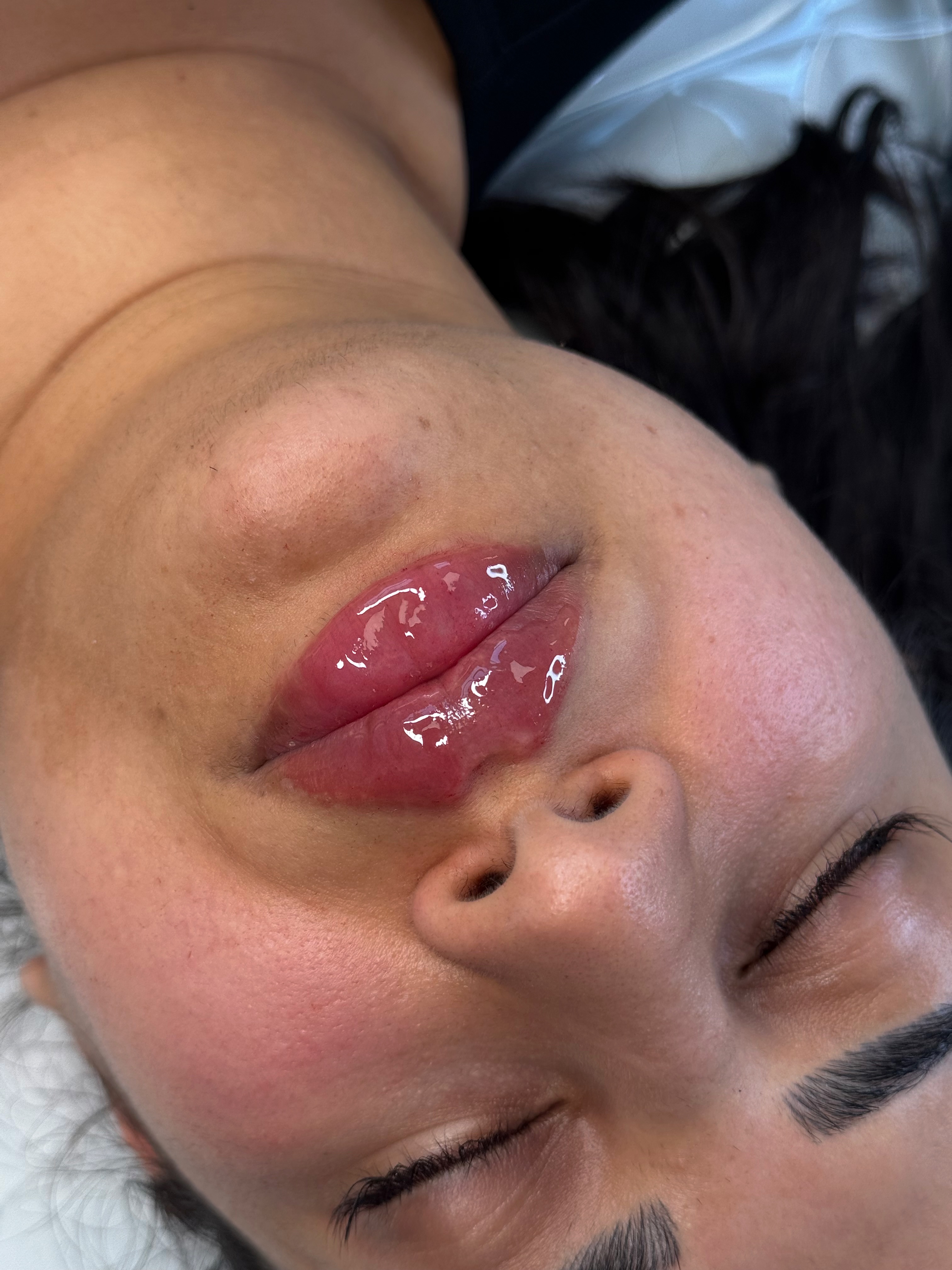 Lip Filler (Augmentation) — treatment results — at The Aesthetics Fix — Southampton