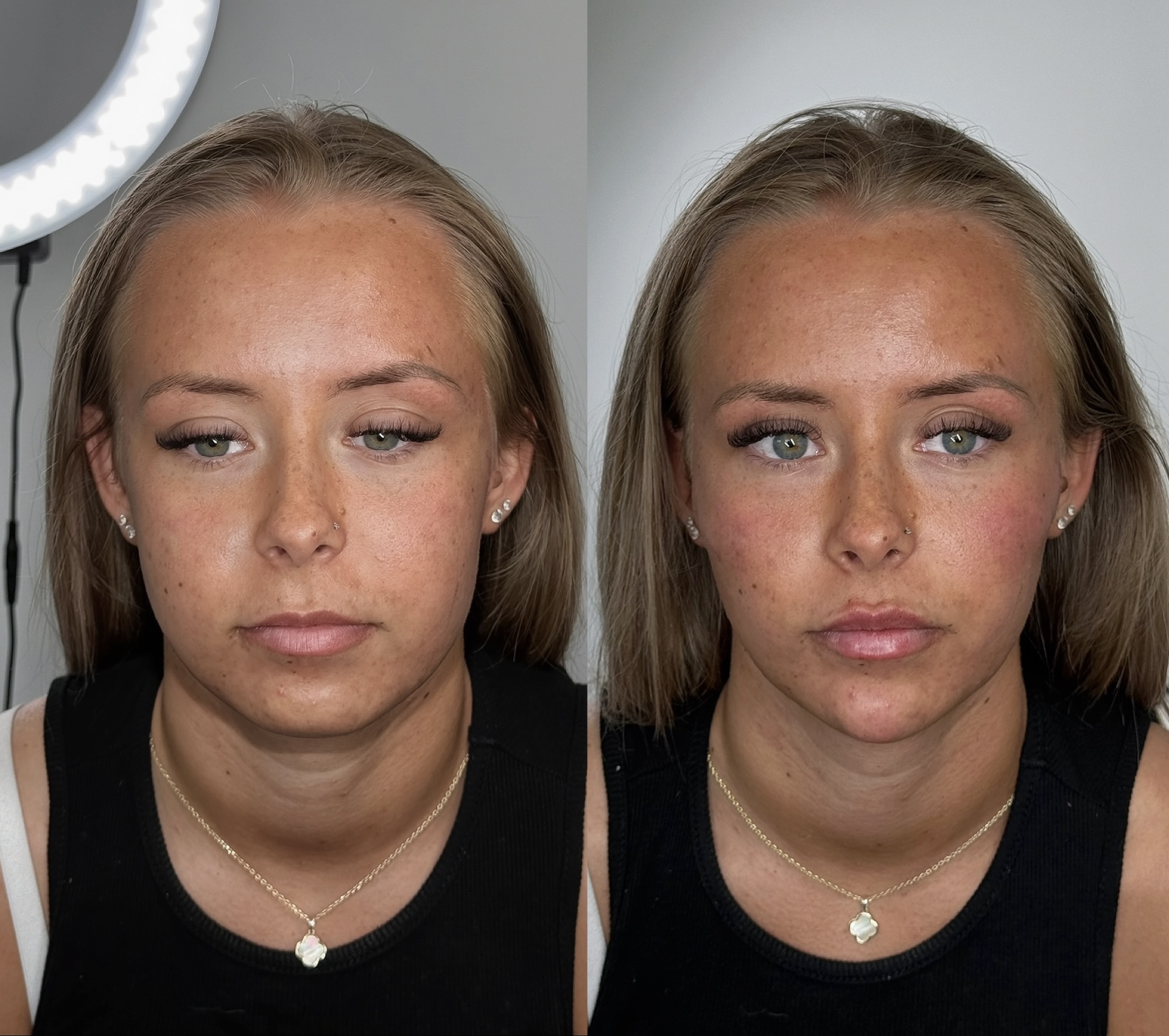 Dermal Filler Injections — before and after results — at The Aesthetics Fix — Southampton