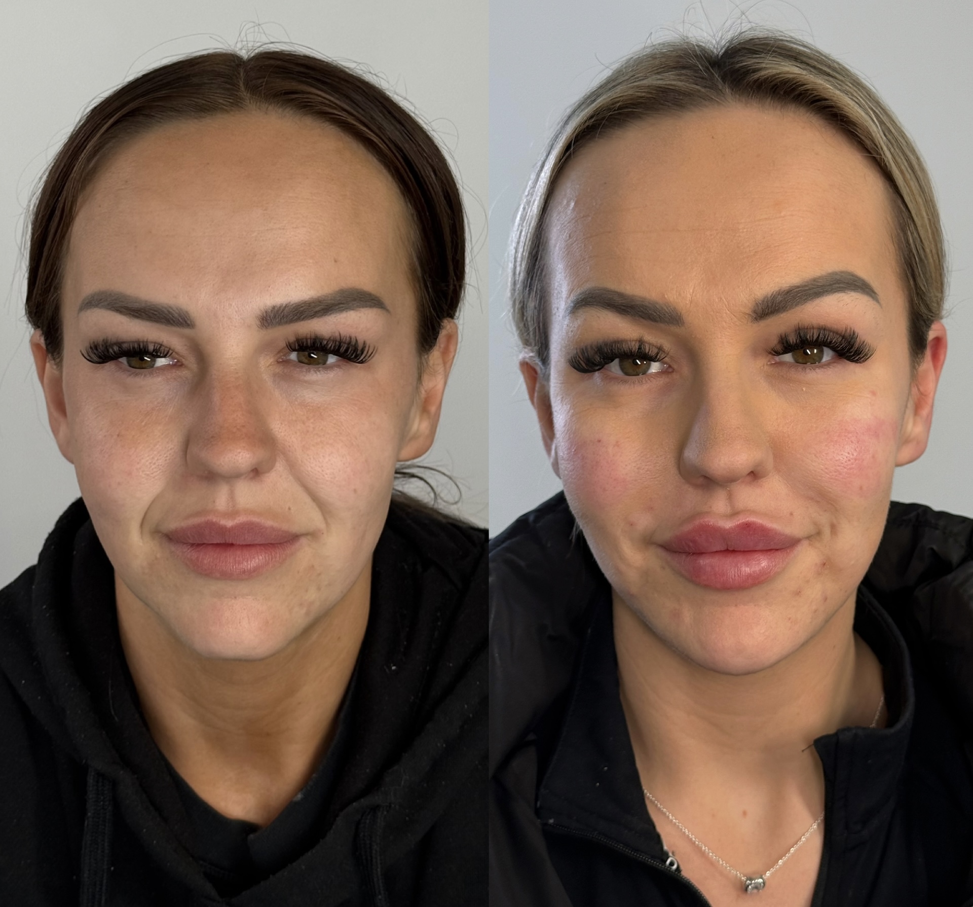 Dermal Filler Injections — before and after results — at The Aesthetics Fix — Southampton