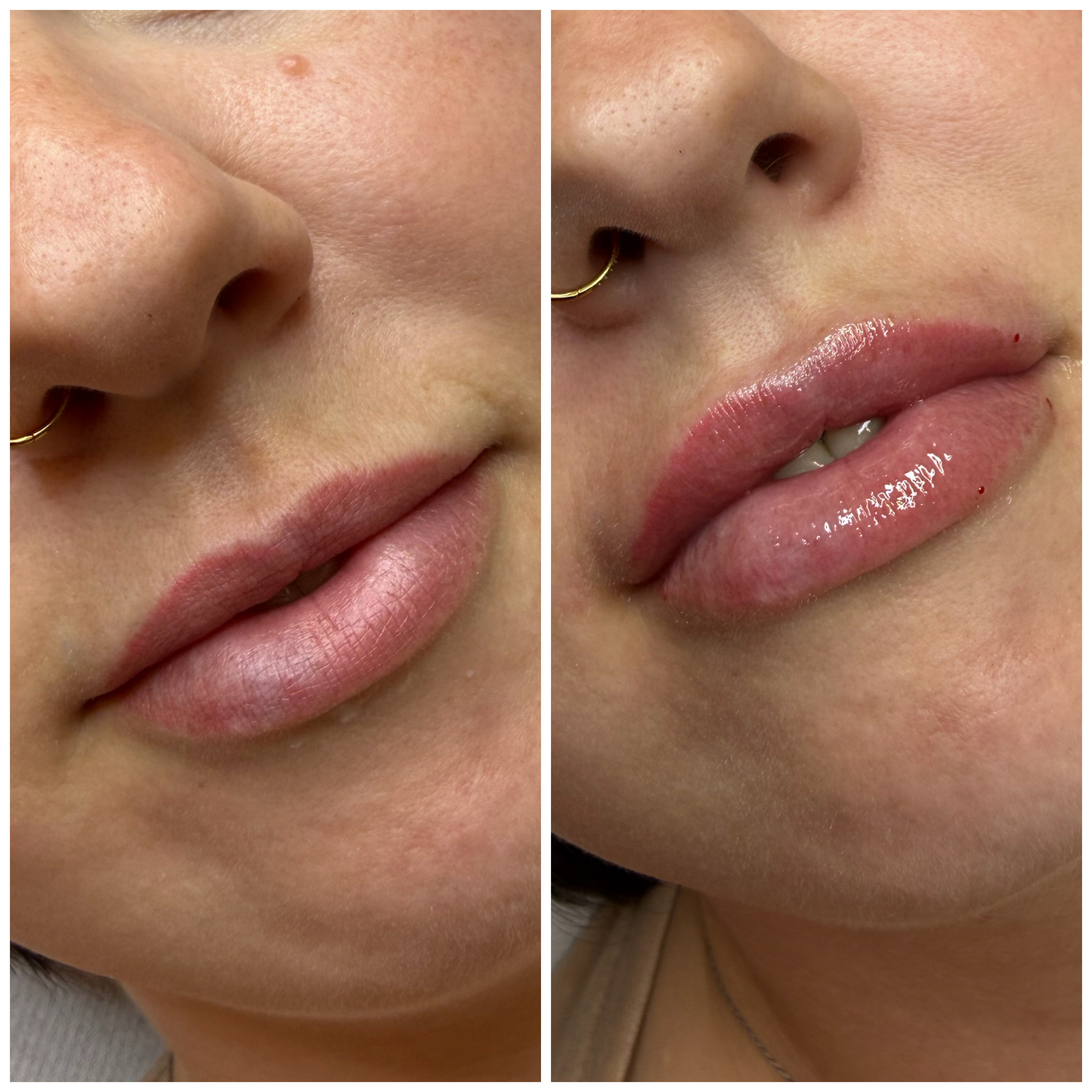 Lip Filler (Augmentation) — before and after results — at Mac Aesthetics — Newtownabbey
